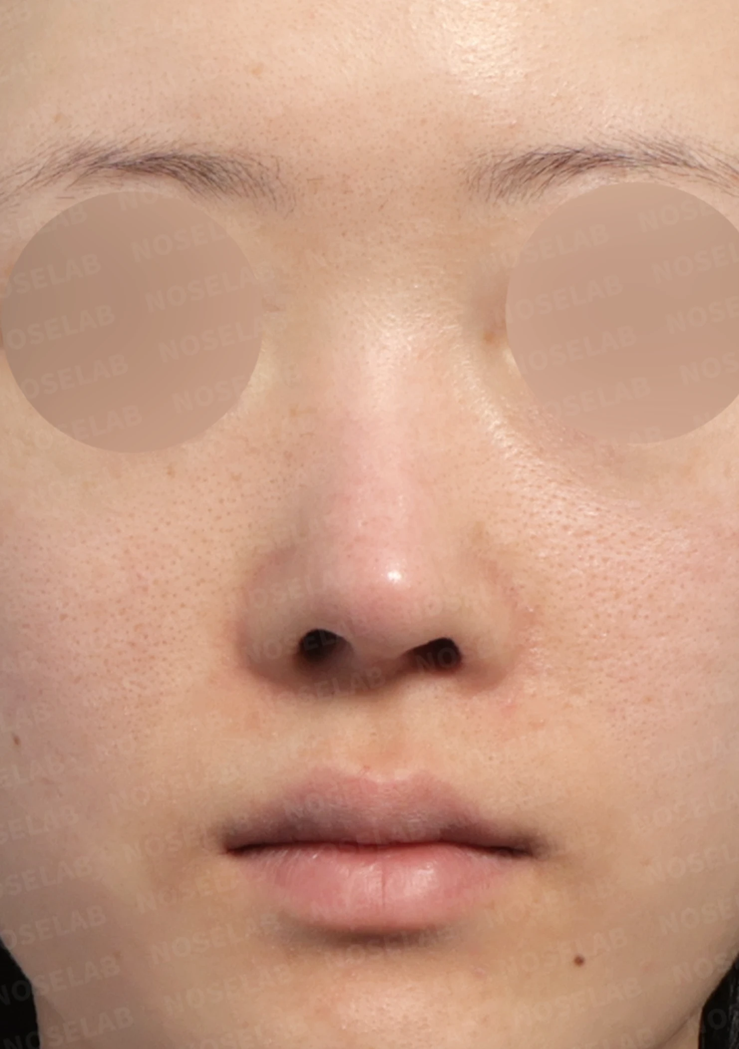 보형물 비침과 들린 코, 자가늑연골로 안전하게 교정한 코재수술 — 전(좌) 직후(후)