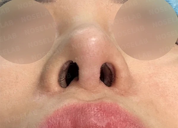긴코 교정은 어떻게 할까요? — 수술 전 / 수술 직후 0일 직후 사진은 부기가 있는 상태로 최종 결과와 다를 수 있습니다.