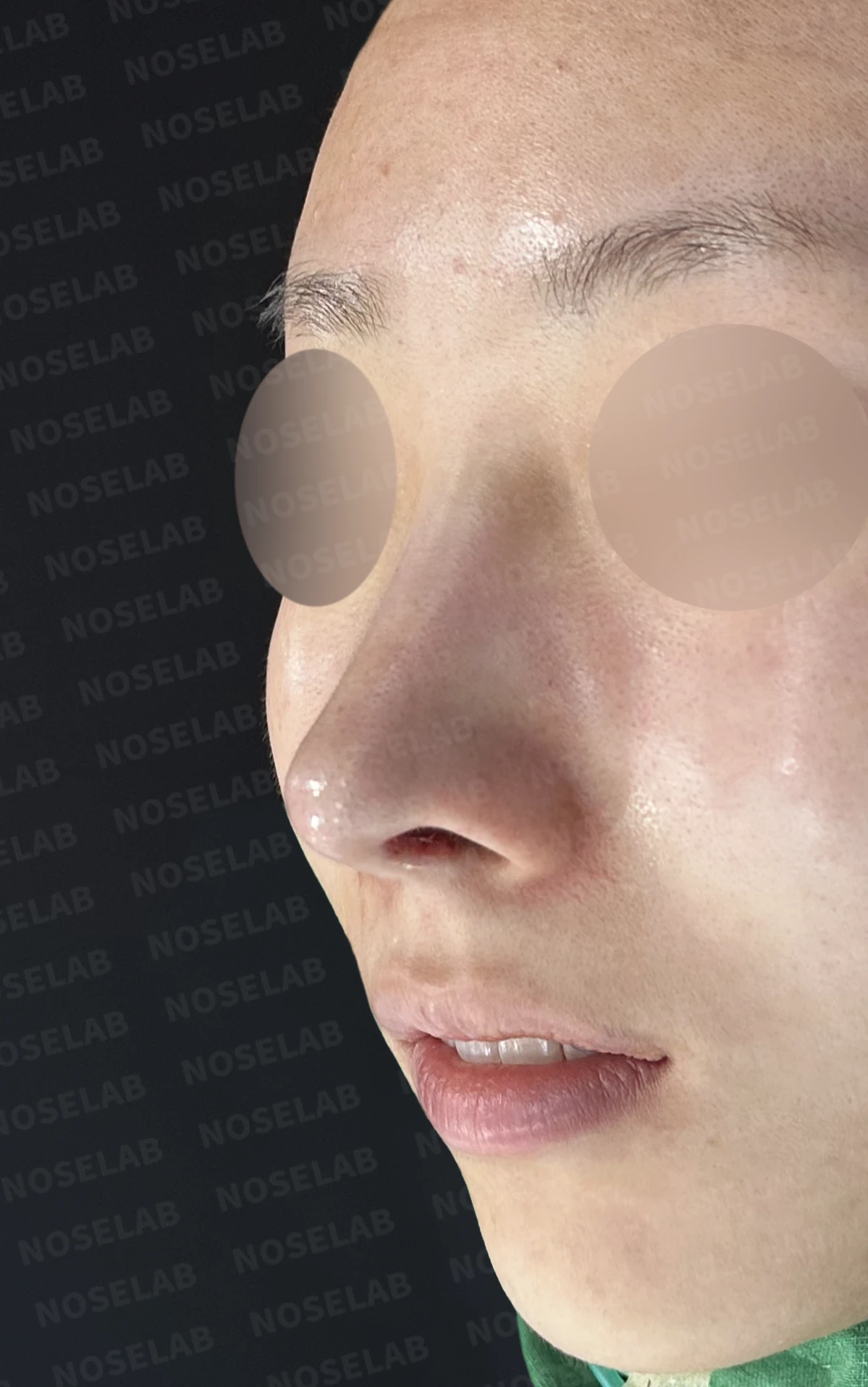 길고 처진 코, 휜코 교정과 코막힘까지 한 번에 해결한 재수술 사례 — 직후 정면, 비스듬한 측면, 측면 사진입니다.