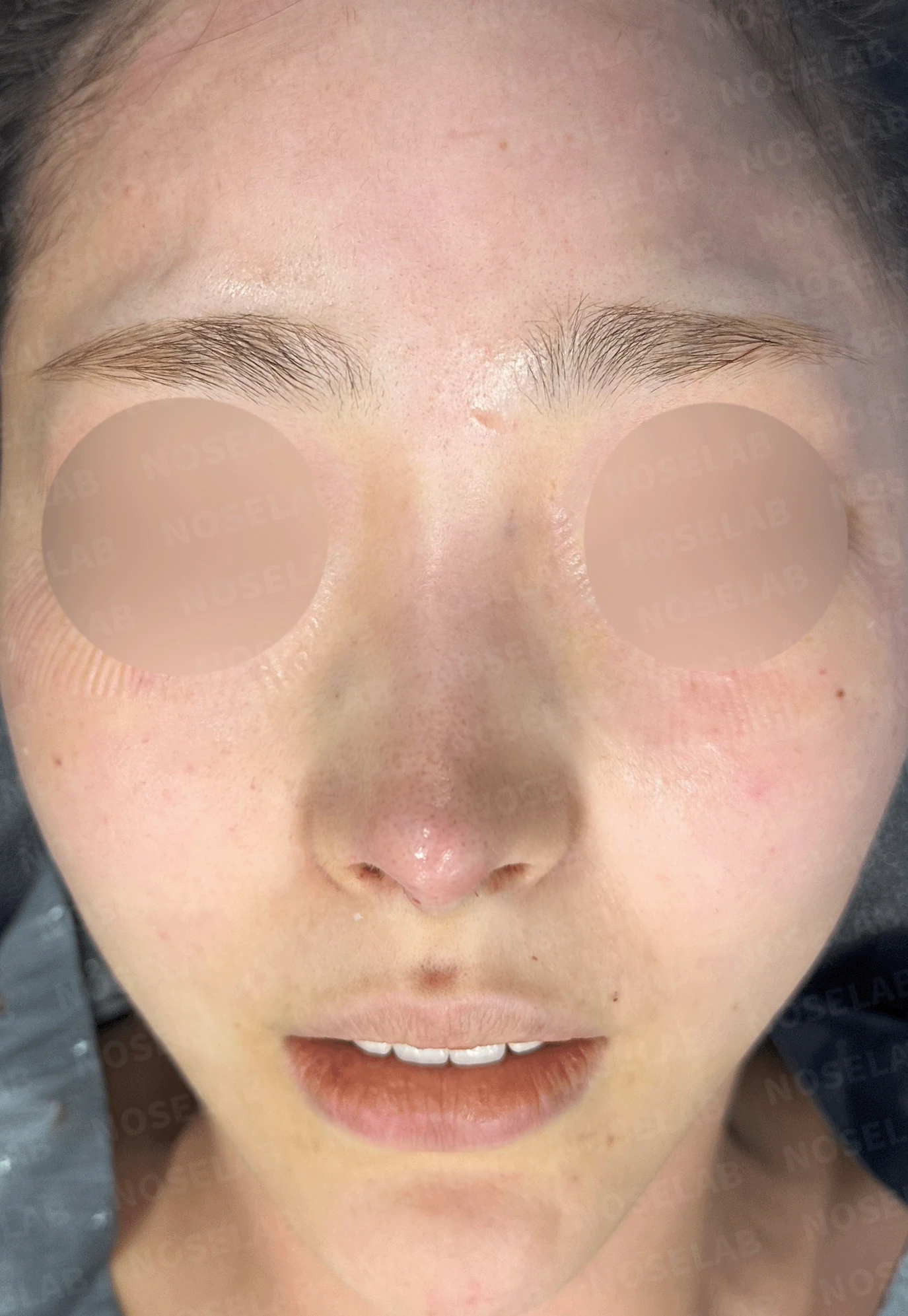 코끝 처짐과 코막힘을 함께 살펴보는 재수술 방법 — 본문 사진 11