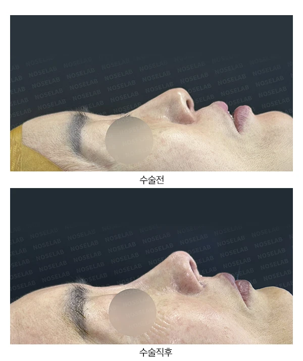 화살코, 긴코 교정 방법 — 전후 비교