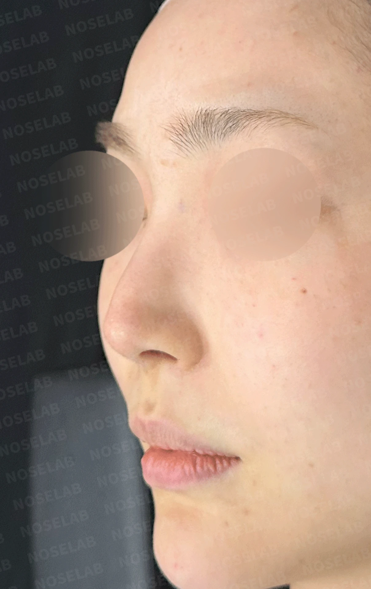 코끝 처짐과 코막힘을 함께 살펴보는 재수술 방법 — 본문 사진 14