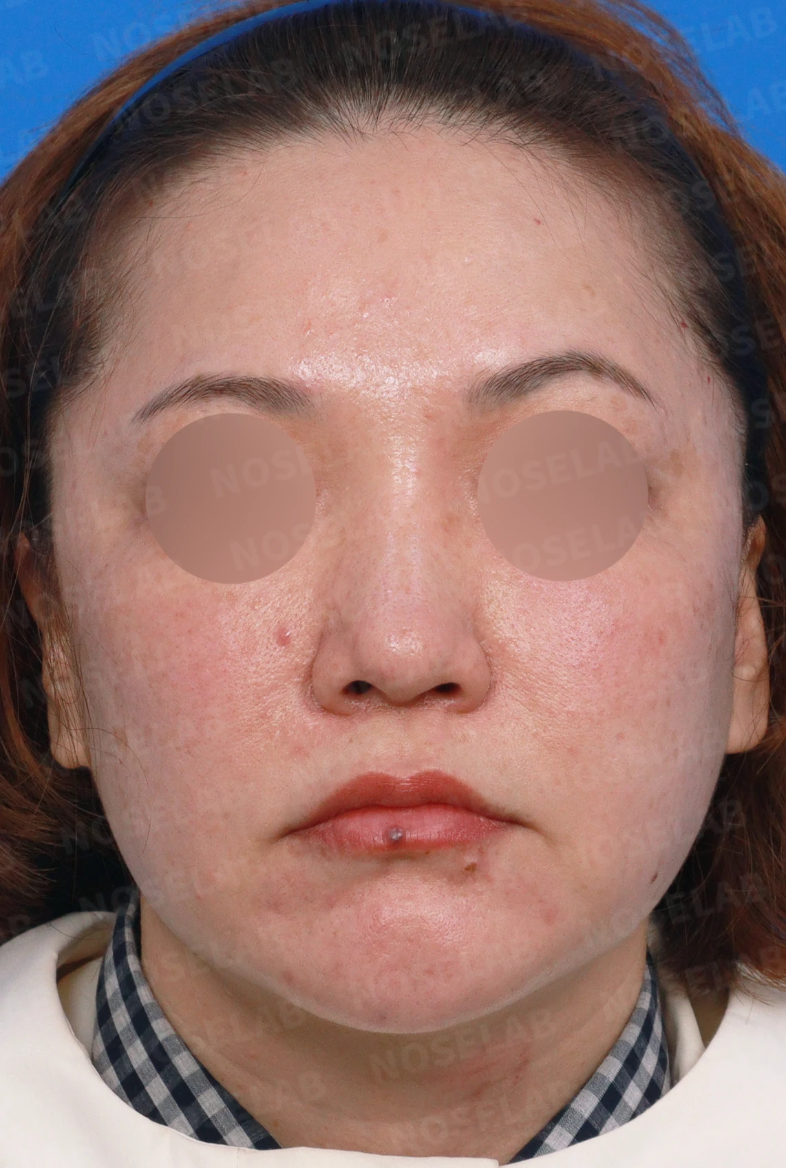 뭉툭하고 길게 처진 코가 중안면부를 길어 보이게 하는 이유, 석회화된 늑연골 재건 방법 — 디자인 상담 정면, 좌측 측면, 비스듬한 측면 사진입니다.