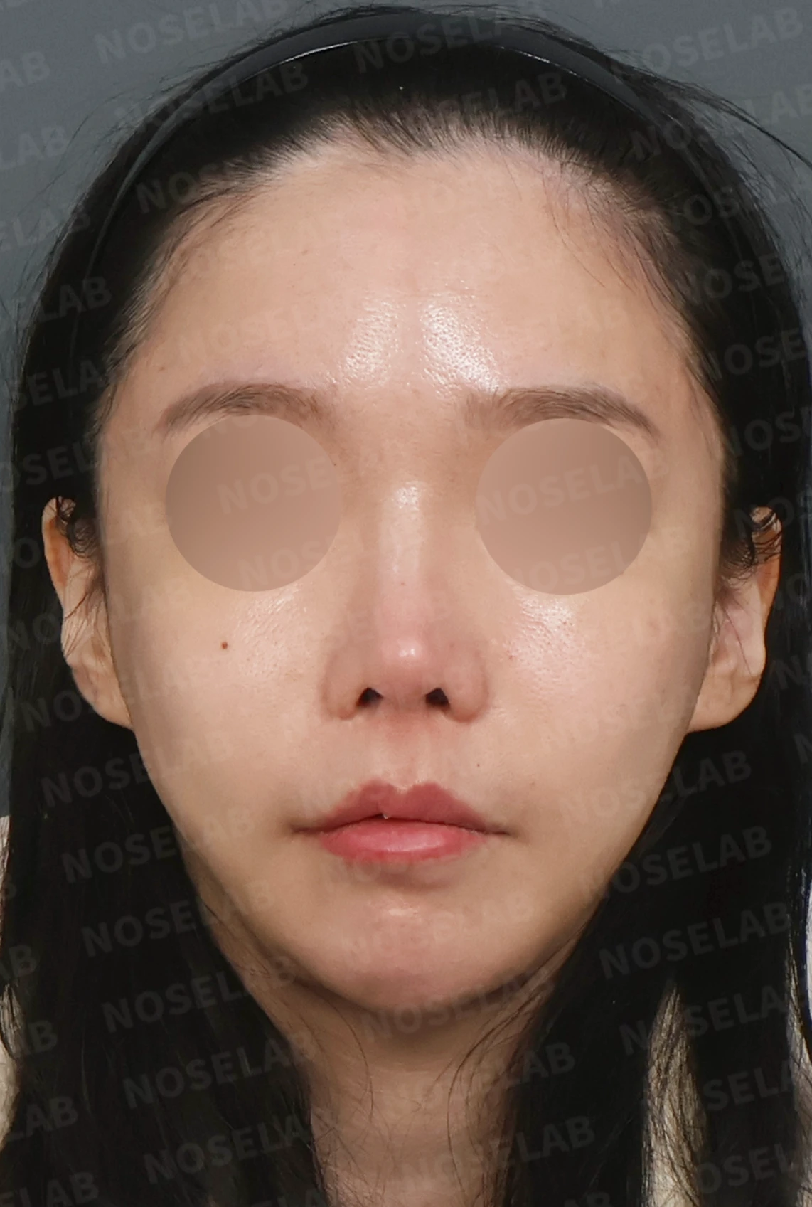 들린코와 비공 비대칭, 기증늑연골로 정교하게 교정한 코재수술 — 디자인 상담 정면, 좌측 측면, 비스듬한 측면 사진입니다.