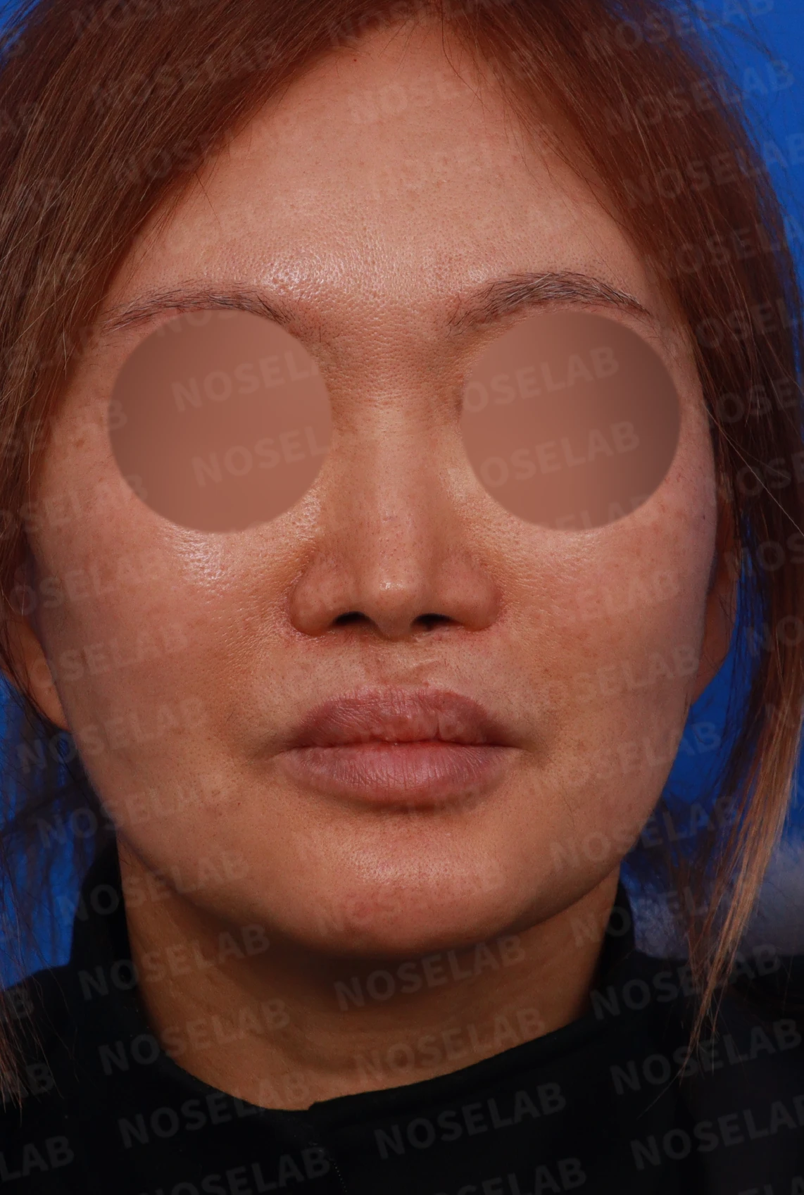 구순구개열 코의 재수술이 까다로운 이유와 늑연골 재건 방법 — 디자인 상담 정면, 좌측 측면, 비스듬한 측면 사진