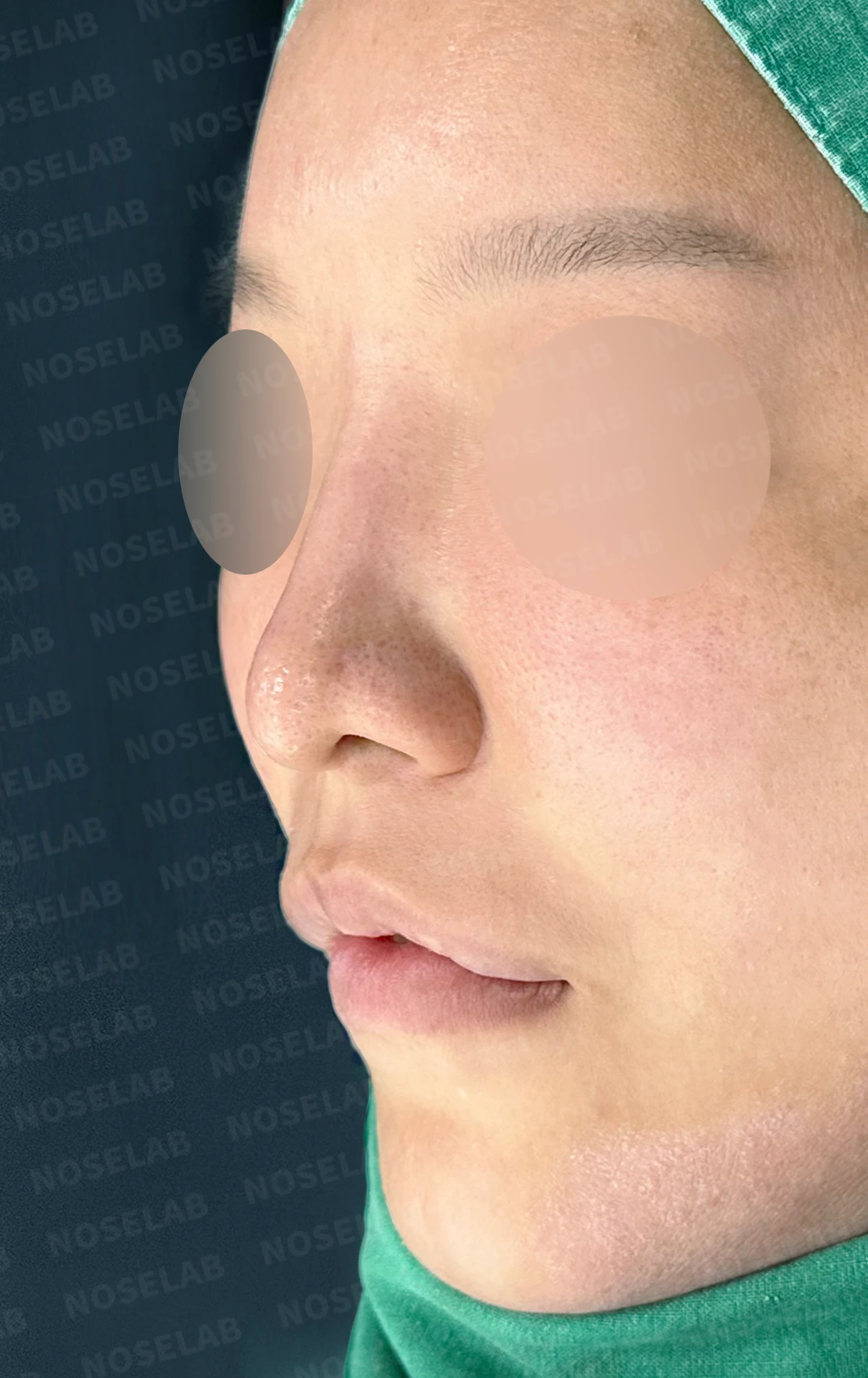 휜 코 교정과 코막힘 개선, 두 마리 토끼를 잡은 성공 사례 — 전(좌) , 직후(후)