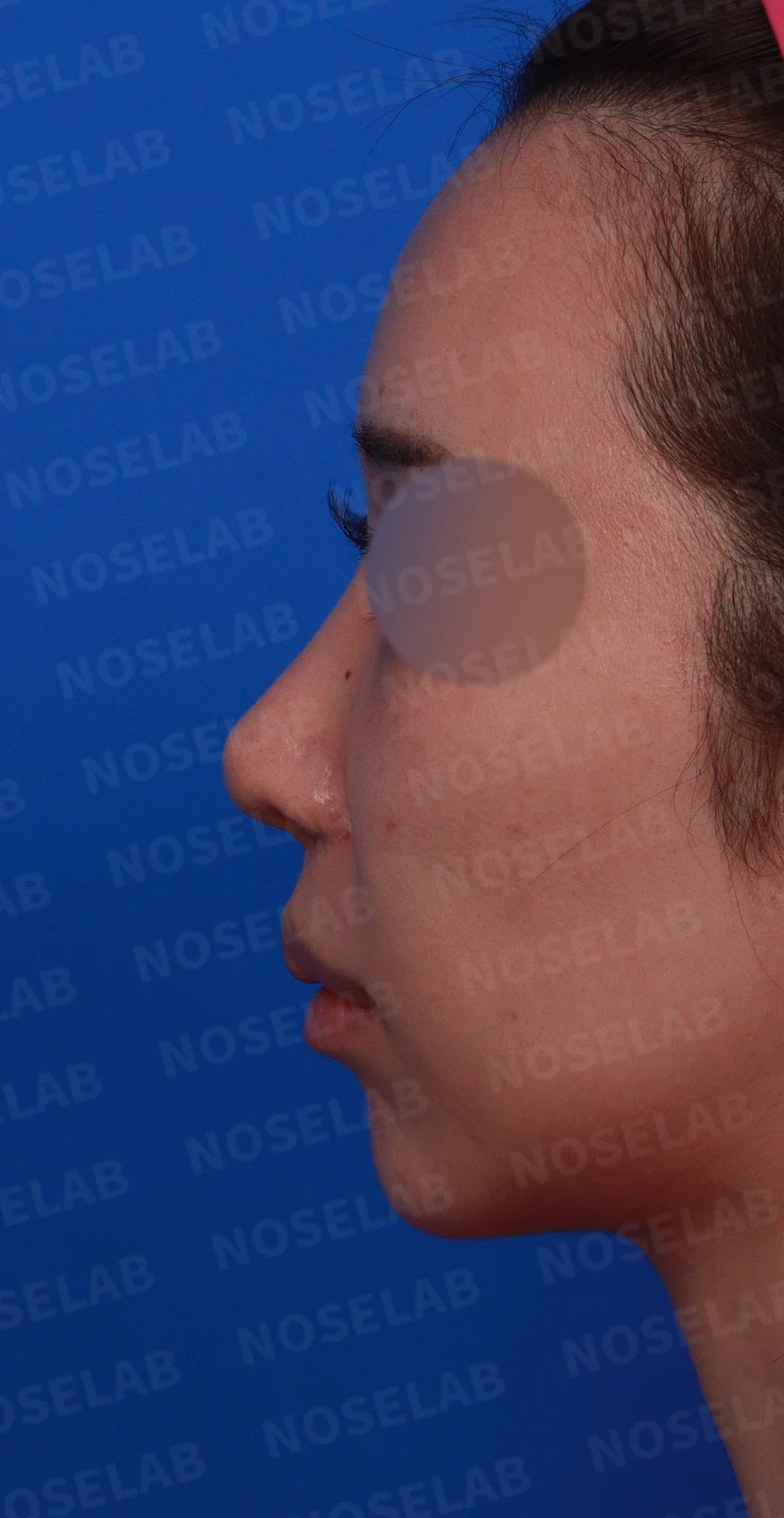 콧구멍 비대칭과 협착이 생기는 이유, 늑연골 재건과 Z성형은 어떻게 하나 — 디자인 상담 정면, 좌측 비스듬한 측면, 측면 사진입니다.