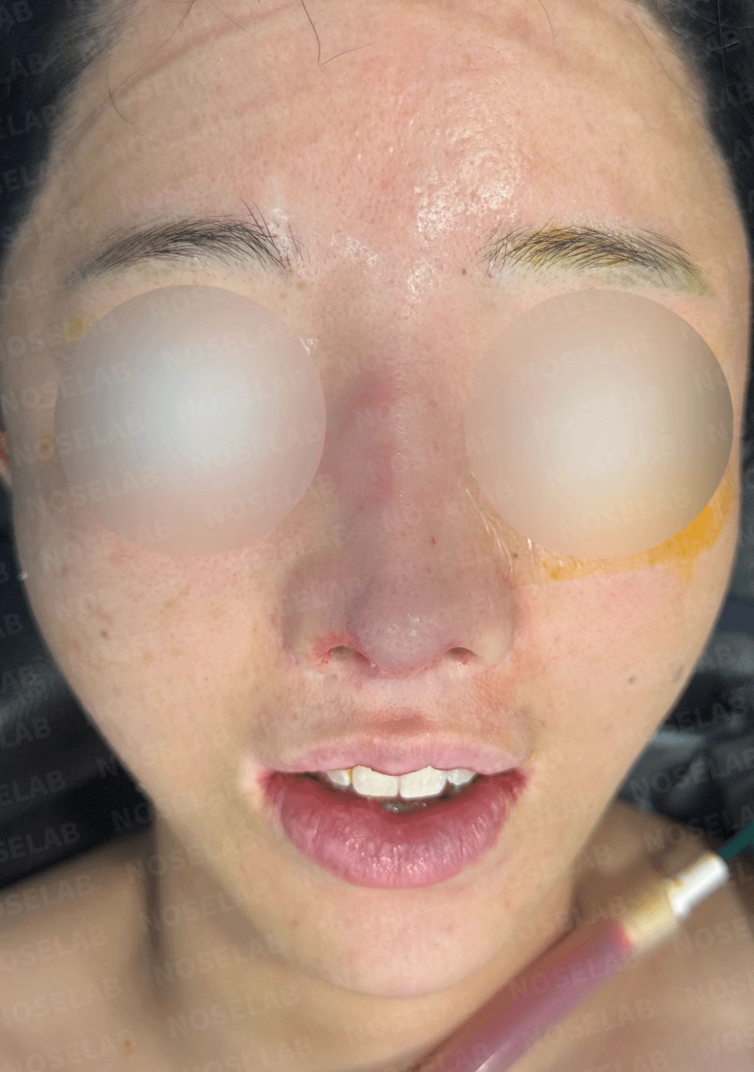 다수 재수술 후 인공진피 흡수와 비중격 손상 재건 사례 — 전(좌) 직후(우)