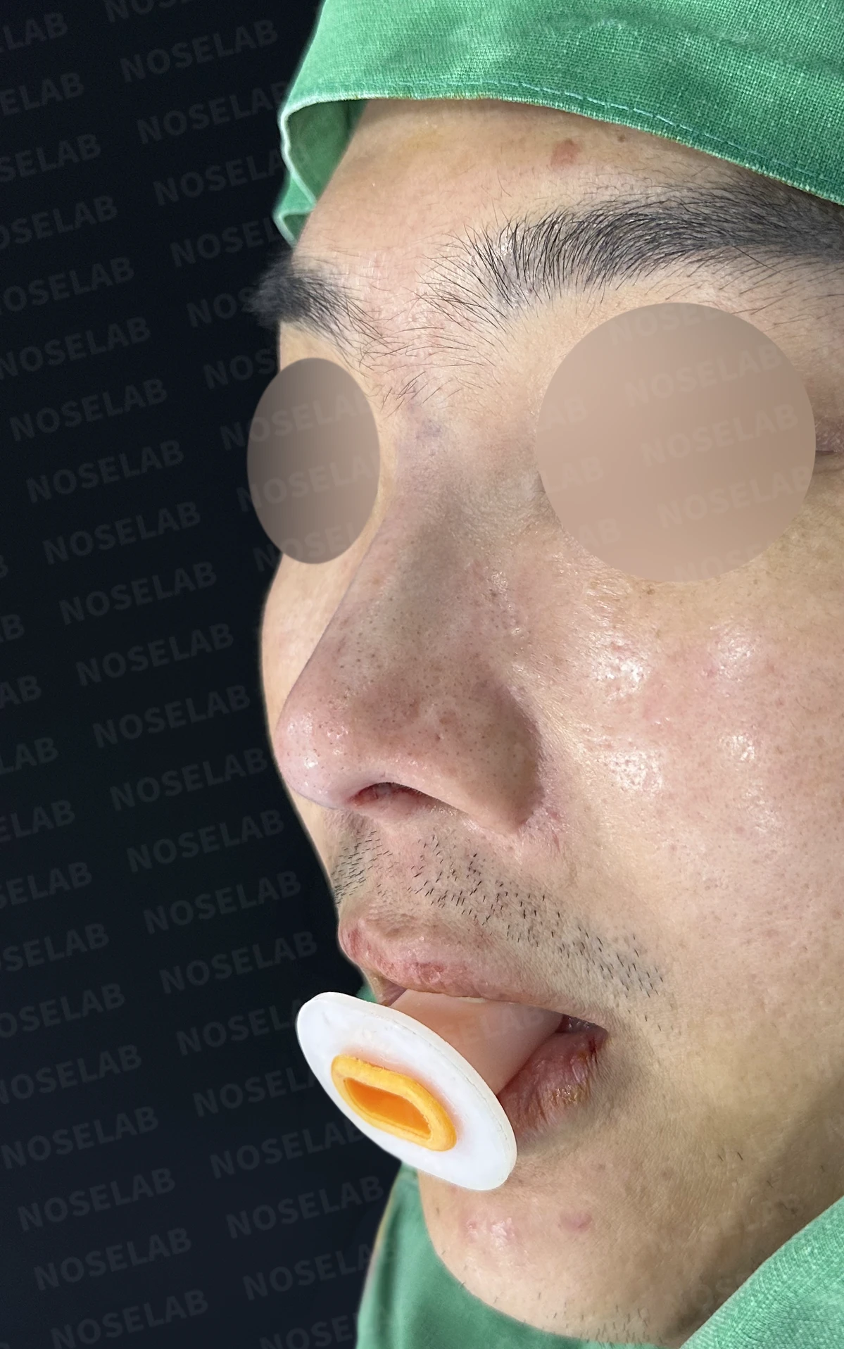 휜코 교정과 비공 비대칭, 자가늑연골로 바로잡은 코재수술 — 수술직후 정면, 비스듬한 측면, 측면 사진입니다.