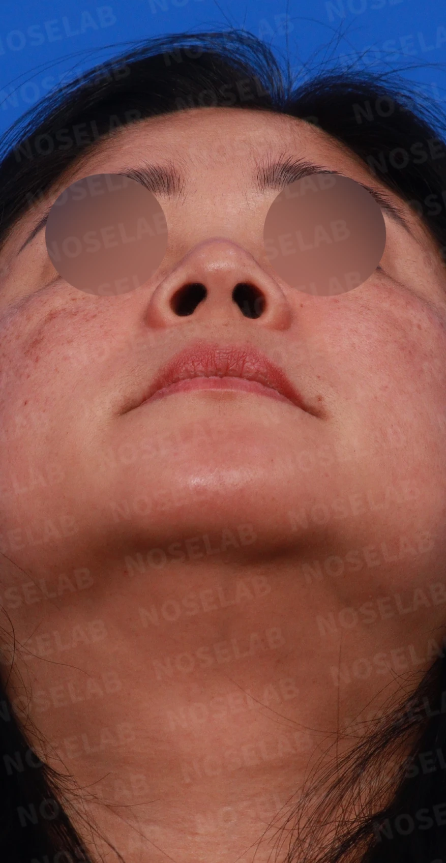 짧은 코와 코막힘을 함께 교정하는 방법 — 디자인 상담 우측 측면, 비스듬한 측면, 비공 사진입니다.