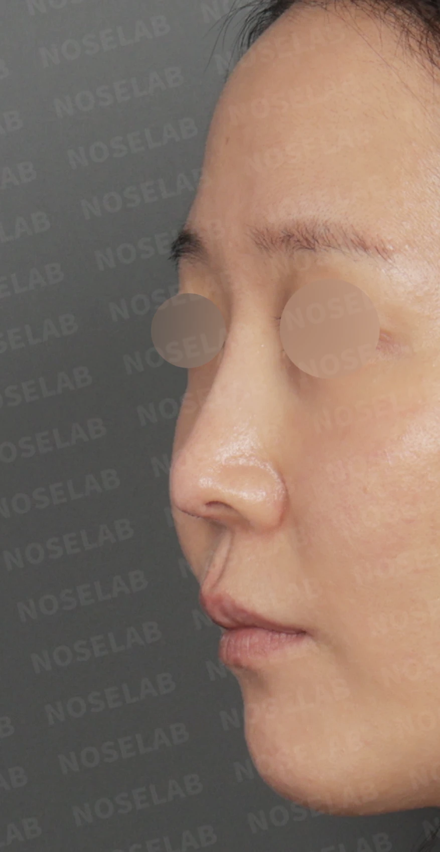 코끝 피부 함몰과 보형물 비침, 자가늑연골로 안전하게 복원한 코재수술 — 디자인 상담 — 정면, 좌측 측면, 비스듬한 측면