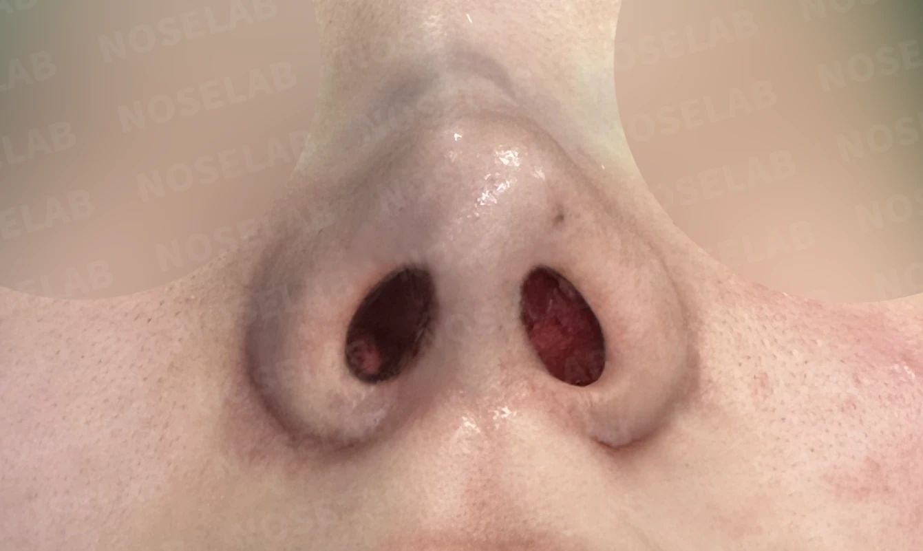 코끝이 퍼져 보이는 이유와 코바닥·비순각을 함께 다루는 방법 — 수술 직후 0일 비공 사진입니다. 직후 사진은 부기가 있는 상태로 최종 결과와 다를 수 있습니다.
