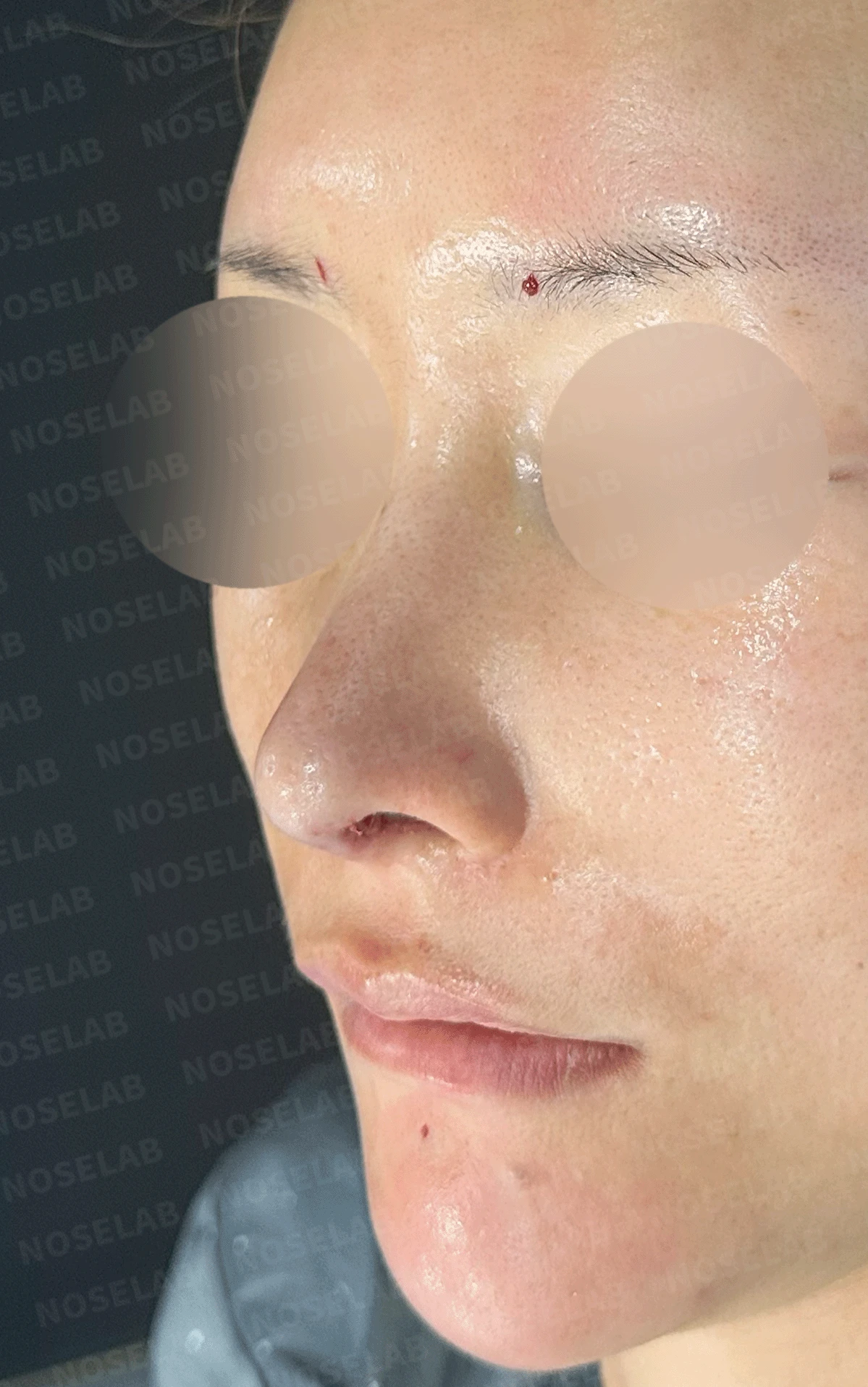 후비루와 코끝 처짐이 함께 나타나는 이유, 비중격 연장과 기능 수술은 어떻게 하나 — 수술 직후 0일 정면 , 측면 , 비스듬한 측면 사진 직후 사진은 부기가 있는 상태로 최종 결과와 다를 수 있습니다.
