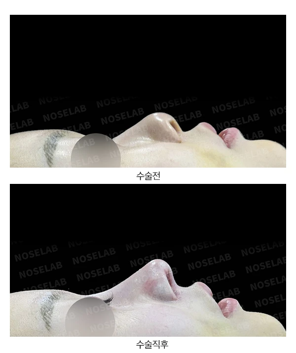 짧은 코 + 들린 코 + 휜 코 + 이물질 제거(실 6가닥) + 콧구멍 비대칭 교정 수술(자가늑연골) — 전후 비교