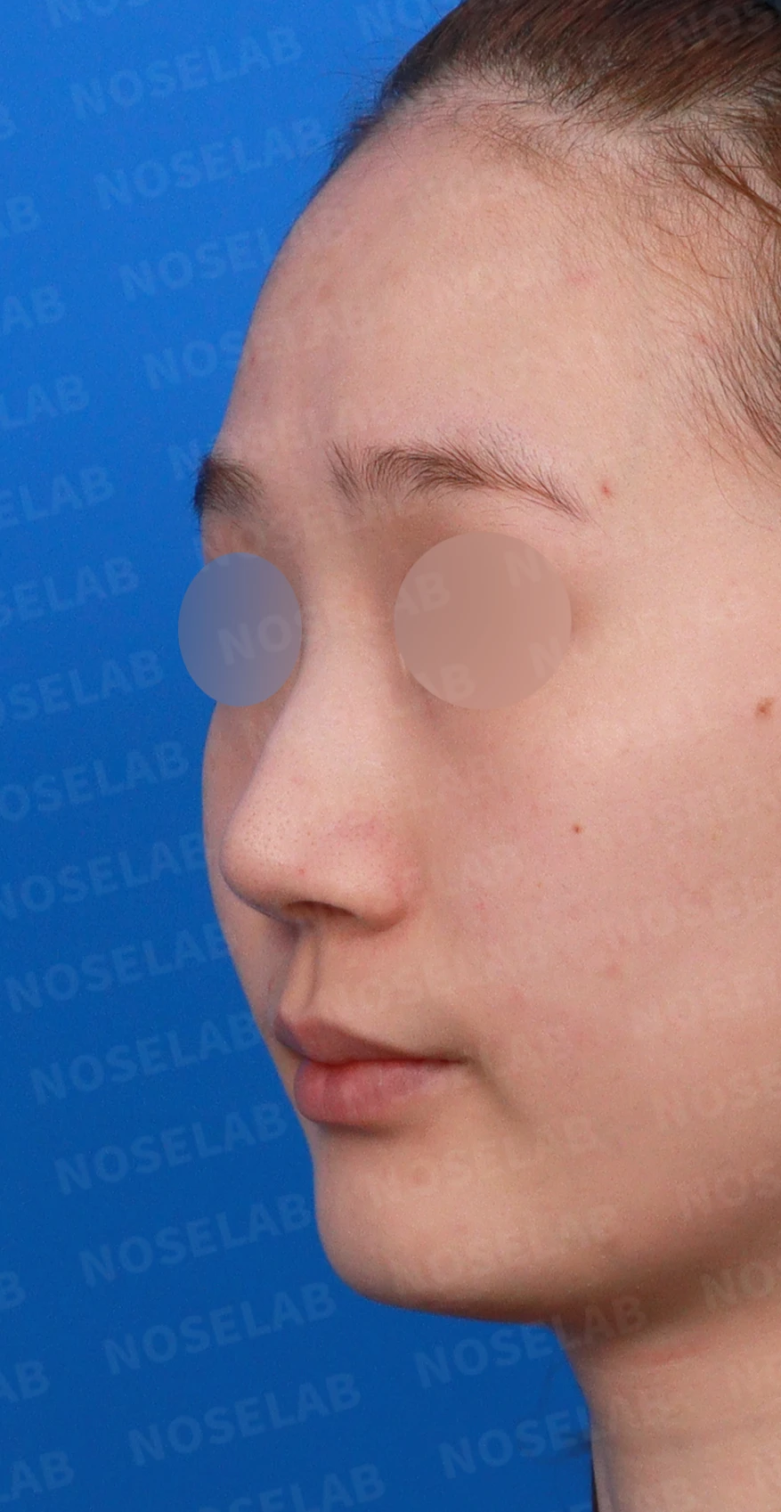 퍼진 코끝에 코막힘이 함께 오는 이유, 이물질 제거와 재건은 어떻게 하나 — 디자인 상담 정면, 좌측 측면, 비스듬한 측면 사진입니다.