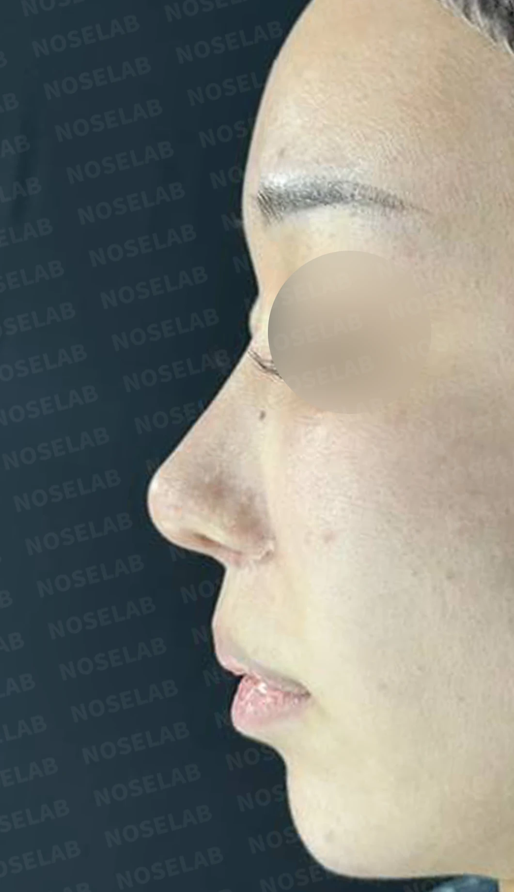 콧구멍 비대칭과 협착이 생기는 이유, 늑연골 재건과 Z성형은 어떻게 하나 — 수술 전 / 수술 직후 0일 직후 사진은 부기가 있는 상태로 최종 결과와 다를 수 있습니다.