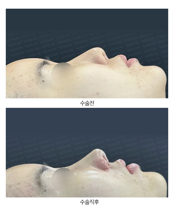 처지고 휜코 교정 방법 — 본문 사진 13