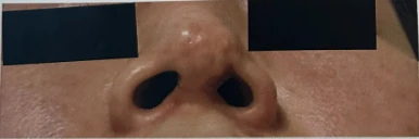 콧구멍을 막는 종괴가 생기는 이유, 제거와 재건은 어떻게 하나 — 본문 사진 9