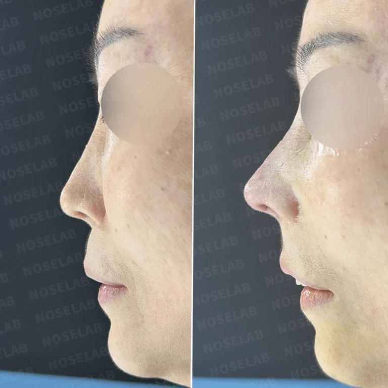 30년간 6차례 수술 후에도 지속된 휘어진 코와 비공 비대칭 - 비중격연골 재건으로 근본 해결 — 전후 비교