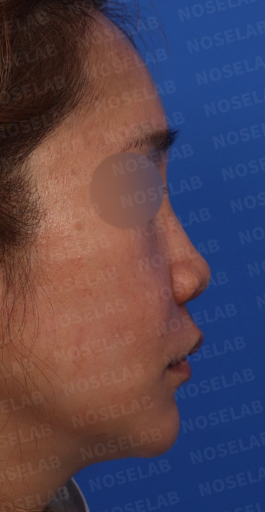 코에 주입된 칼슘필러의 제거와 재건 방법 — 돌출입 소견 관찰 코끝과 콧대 높이가 낮아 전체적으로 밋밋해 보임 비스듬한 측면 사진: