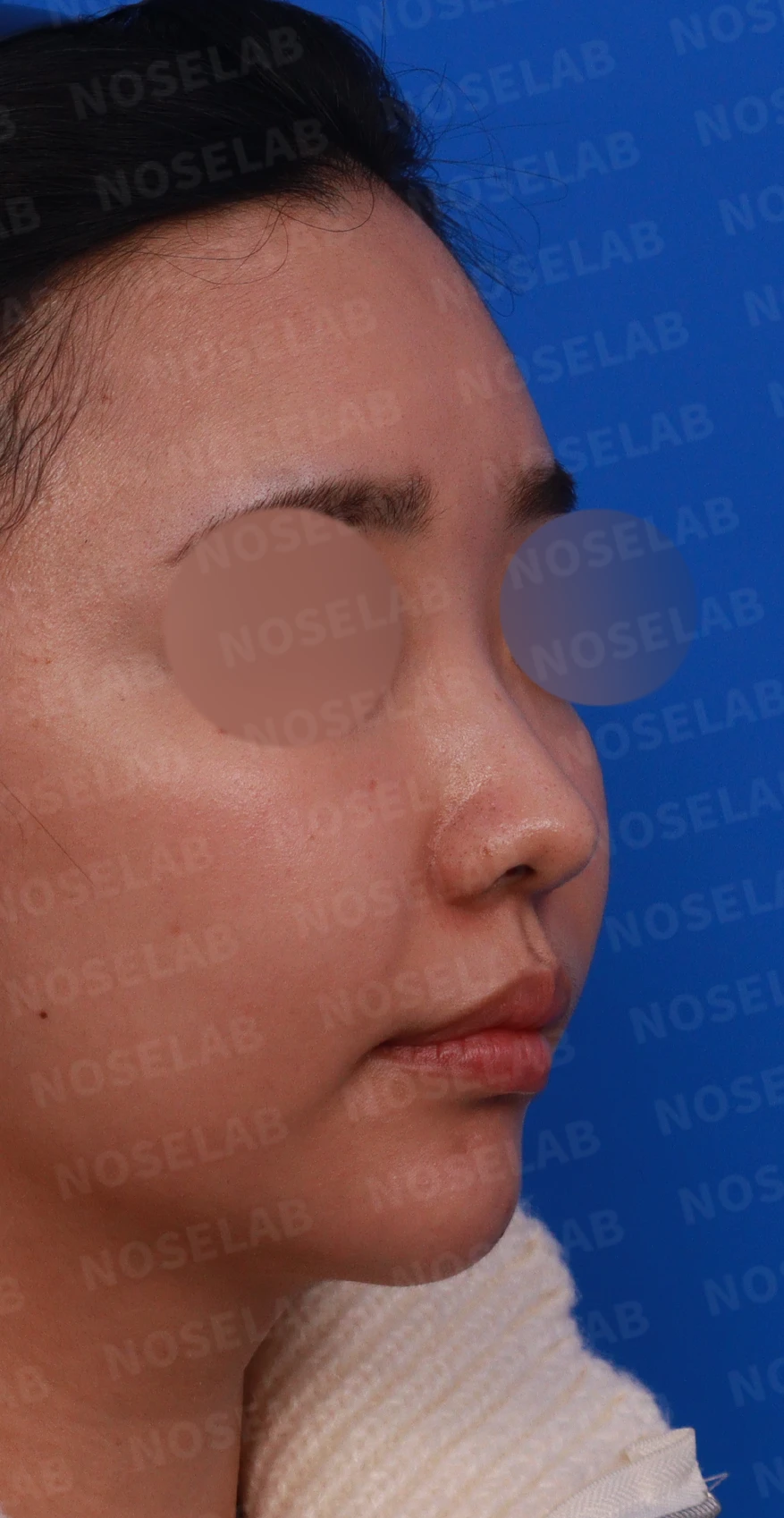 비염 수술을 받았는데도 코막힘이 돌아오는 이유, 구조 교정은 어떻게 하나 — 디자인 상담 우측 측면, 비스듬한 측면, 비공 사진