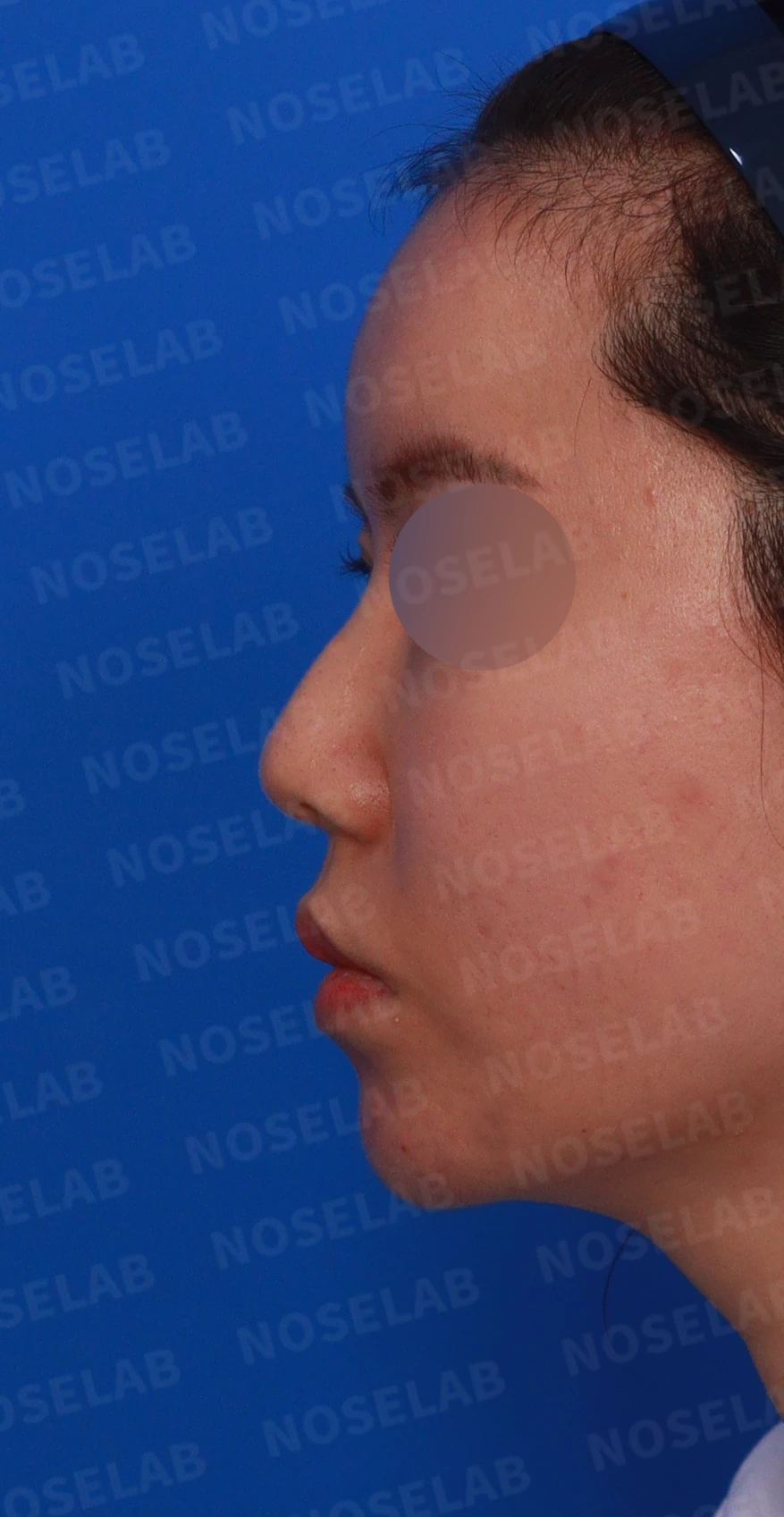 녹지 않고 남은 코 필러와 넓은 콧날개, 원인과 제거·교정 방법 — 디자인 상담 정면 , 좌측 측면 ,비스듬한 측면 사진입니다.