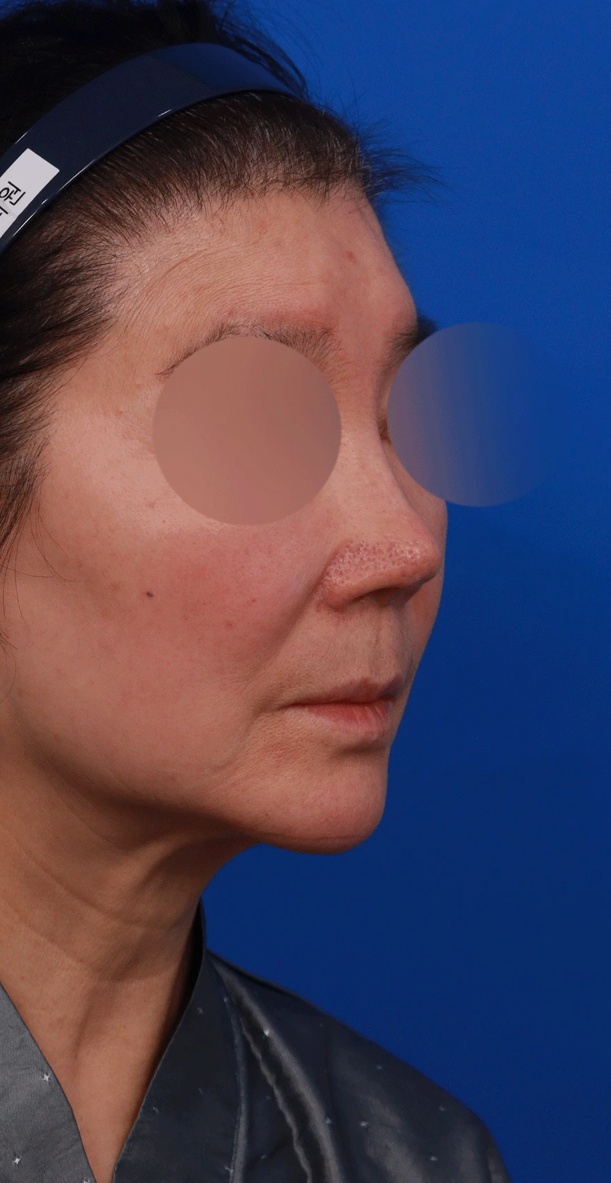 오래된 코 보형물과 코 통증, 재수술에서 확인할 점 — 디자인 상담 우측 비스듬한 측면, 측면, 비공 사진입니다.