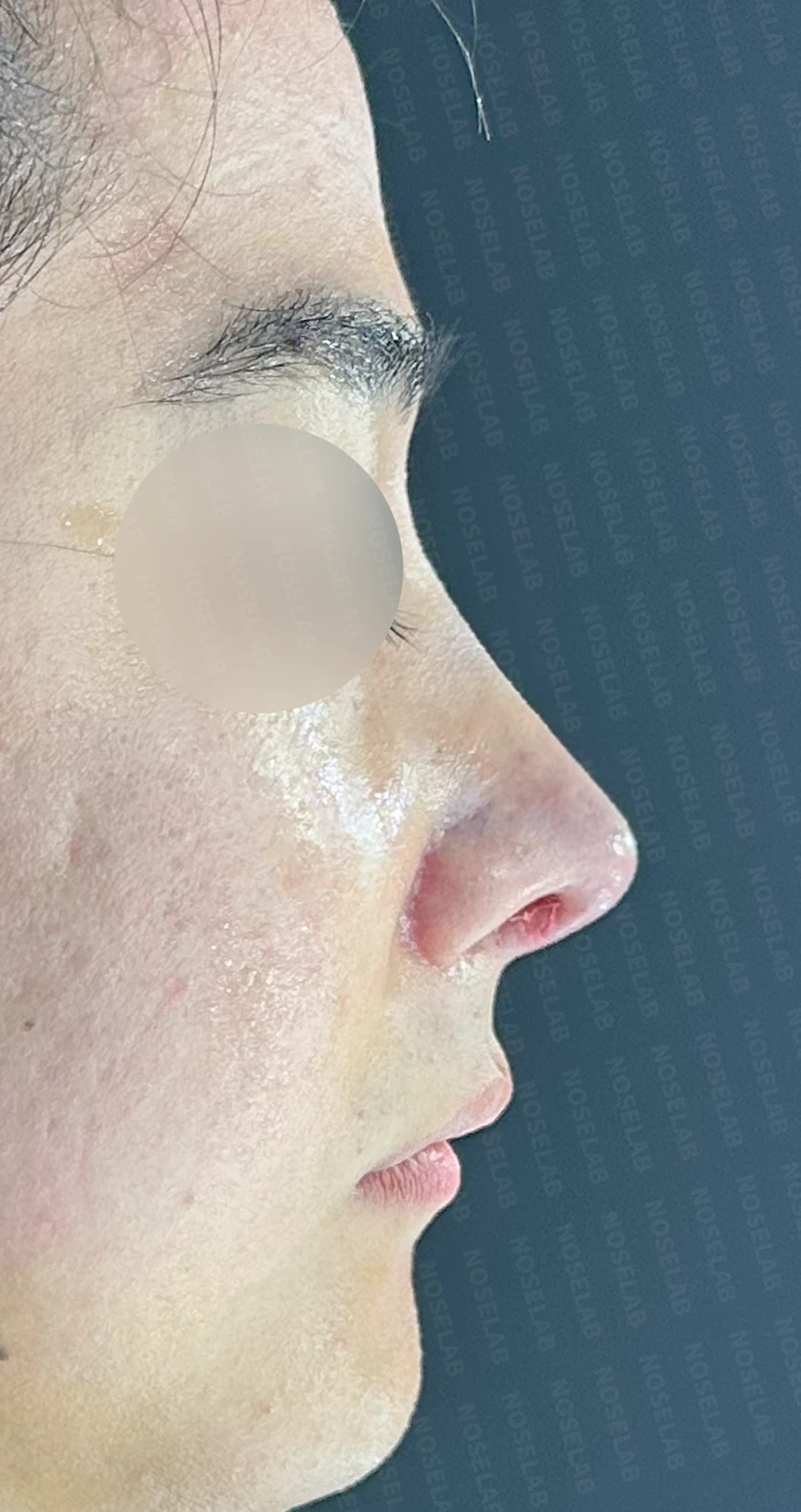 짧고 낮은 코의 지지 구조와 교정 방법 — 수술 직후 0일 정면, 측면, 비스듬한 측면 직후 사진은 부기가 있는 상태로 최종 결과와 다를 수 있습니다.
