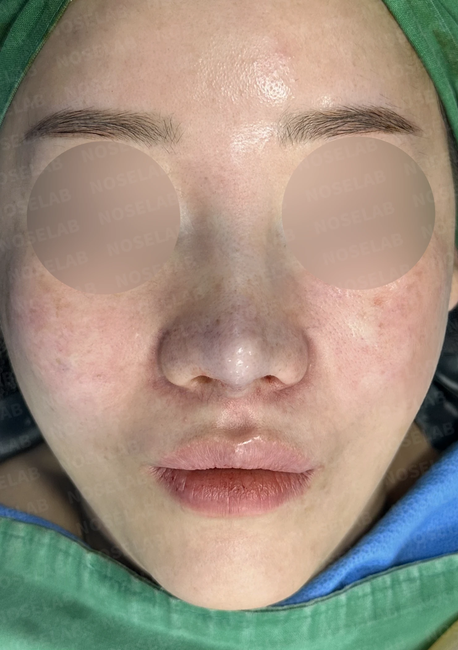 비주 함몰과 콧날개 변형, 자가늑연골을 이용한 코재수술로 자연스럽게 교정 — 전(좌) 직후(후)