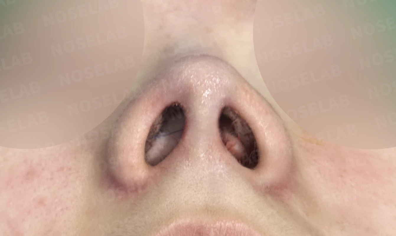 콧대가 퍼져 보이고 코끝이 뭉툭한 이유, 절골술과 자가 늑연골 교정은 어떻게 하나 — 수술 전 / 수술 직후 0일 직후 사진은 부기가 있는 상태로 최종 결과와 다를 수 있습니다.