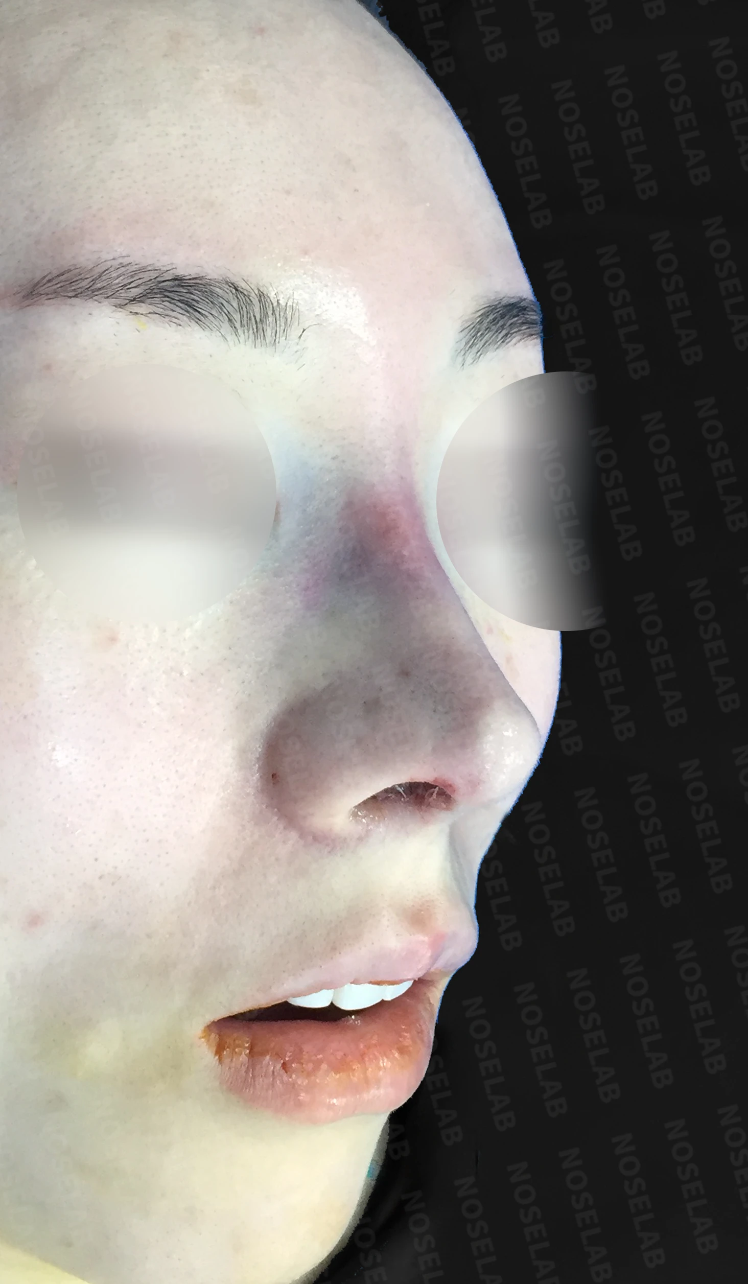 뭉툭한 복코의 구조와 교정 방법 — 수술 직후 0일 정면, 비스듬한 측면, 측면 사진 직후 사진은 부기가 있는 상태로 최종 결과와 다를 수 있습니다.