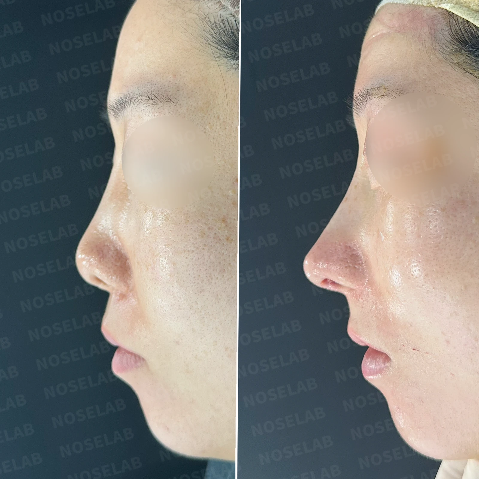 콧대 시작점이 높고 코가 휘어 보이는 이유, 자가 늑연골 교정은 어떻게 하나 — 본문 사진 20