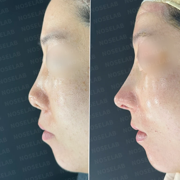 콧대 시작점이 높고 휘어진 코, 자가늑연골로 자연스럽게 교정하기 — 전후 비교