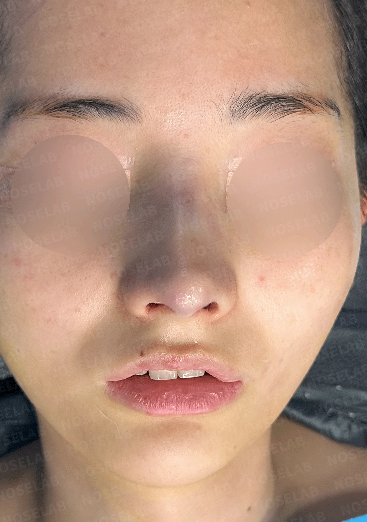 웃을 때만 화살코가 되는 이유와 코끝 연골 교정 방법 — 수술 직후 0일 정면, 비스듬한 측면 , 측면 사진 직후 사진은 부기가 있는 상태로 최종 결과와 다를 수 있습니다.