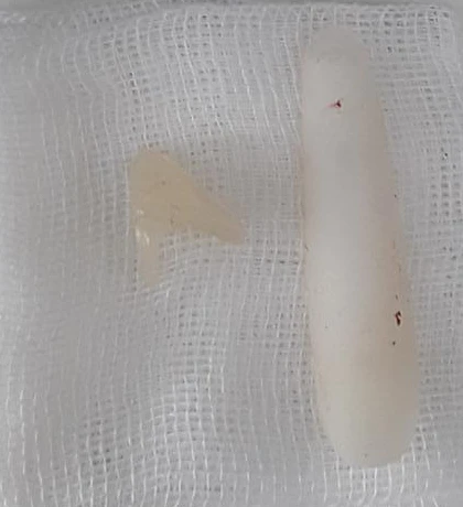 고양이 보형물 제거와 자연스러운 코 재건 - 휘어진 코성형 후기 — 제거된 고양이 보형물과 실리콘 보형물 사진