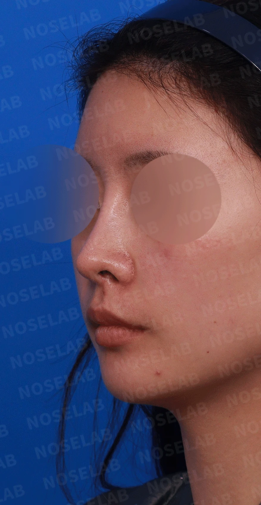 콧대가 인위적으로 보이고 코가 들리는 이유, 재건은 어떻게 하나 — 디자인 상담 정면 , 비스듬한 측면 사진, 좌측 측면