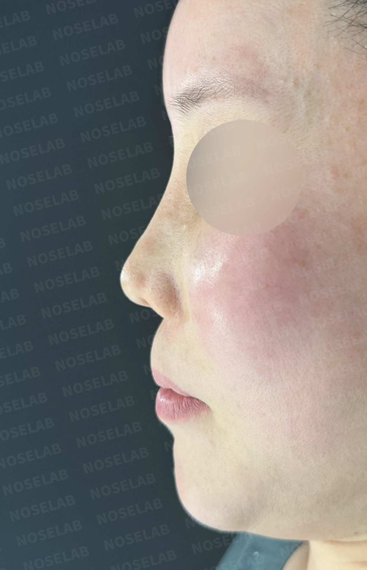 귀족수술 보형물이 코 안으로 밀려 나와 숨이 막히는 이유와 재건 방법 — 본문 사진 10