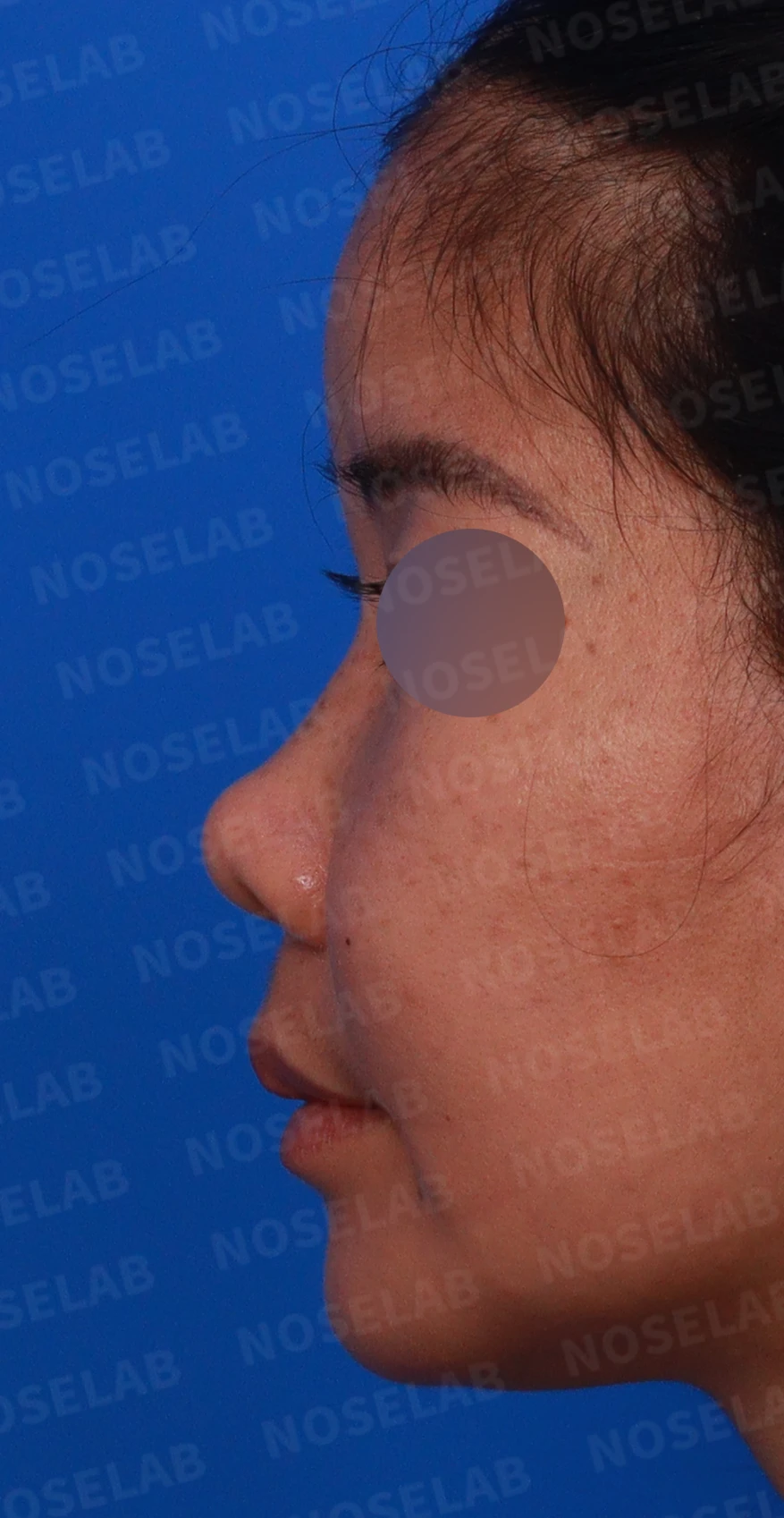 콧대가 평행선처럼 보이는 조건과 콧구멍 모양을 정하는 기준 — 디자인 상담 정면 , 좌측 비스듬한 측면 , 측면 사진입니다.
