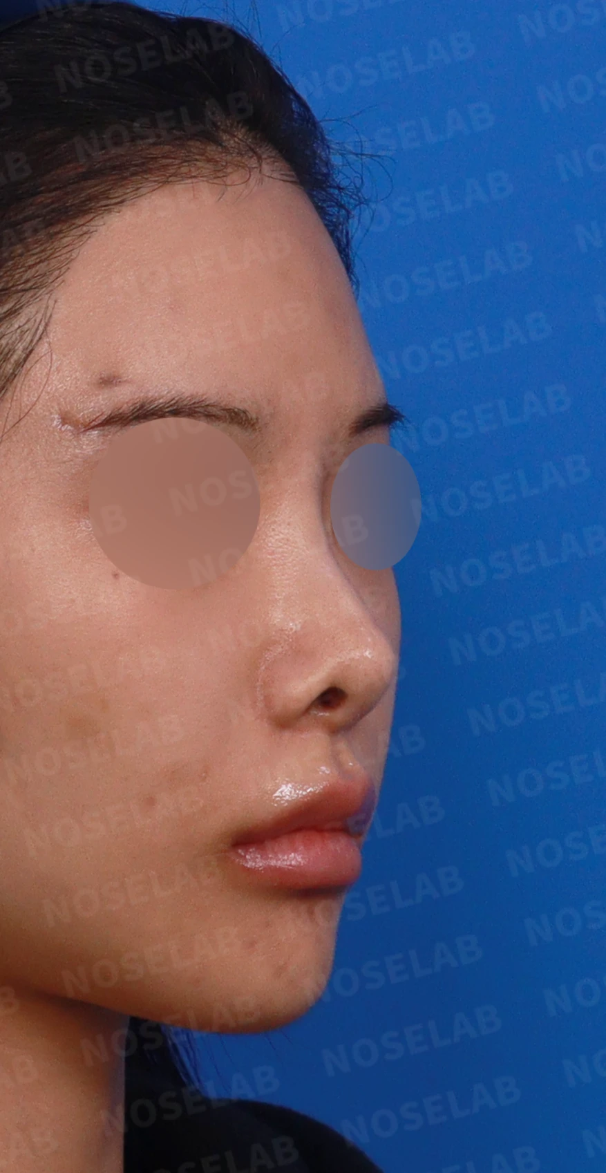 콧대 반영구 필러가 남기는 변화와 제거 후 비중격 재건 — 디자인 상담 우측 측면, 비스듬한 측면, 비공 사진입니다.
