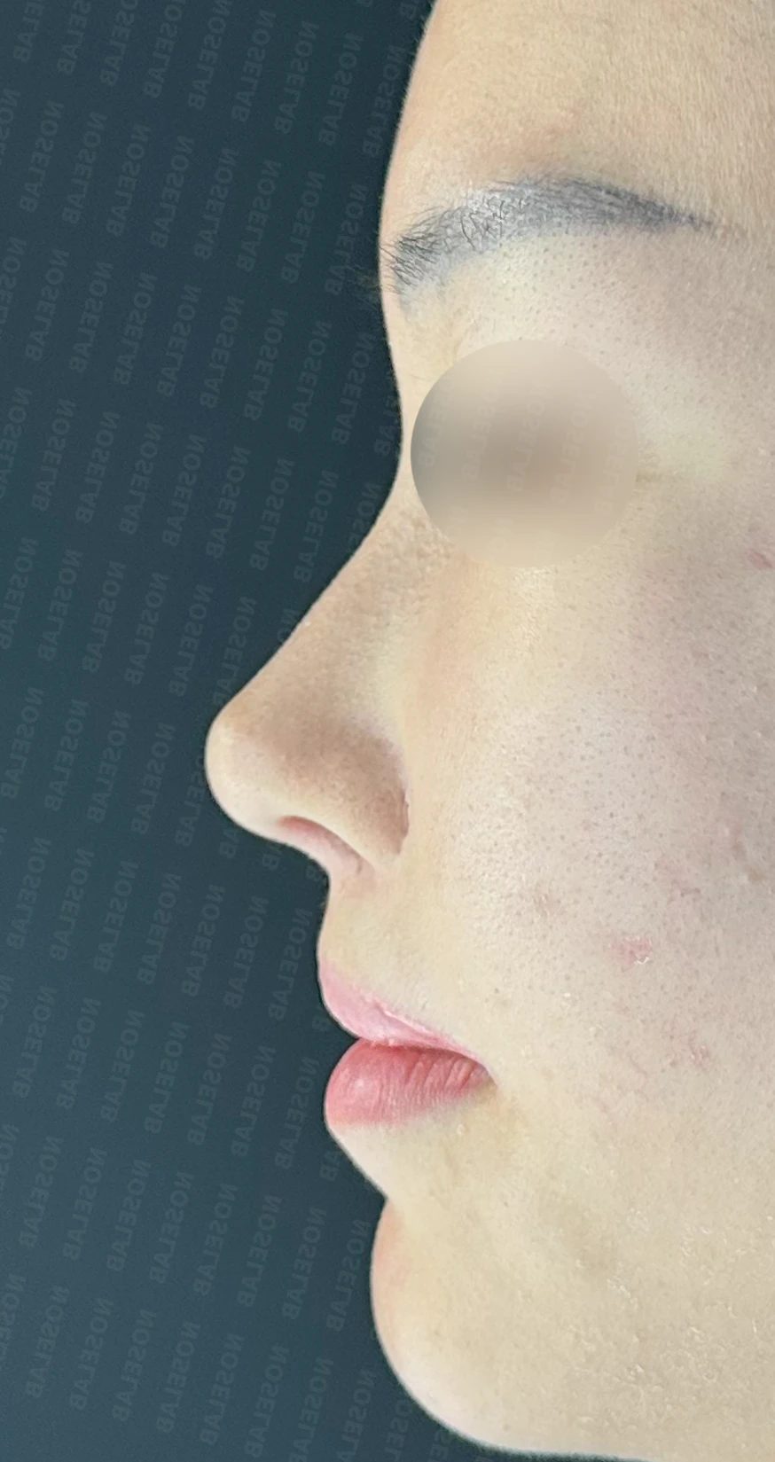 원하는 코 모양과 현재 구조를 함께 살펴보는 수술 계획 — 수술 전 / 수술 직후 0일 직후 사진은 부기가 있는 상태로 최종 결과와 다를 수 있습니다.