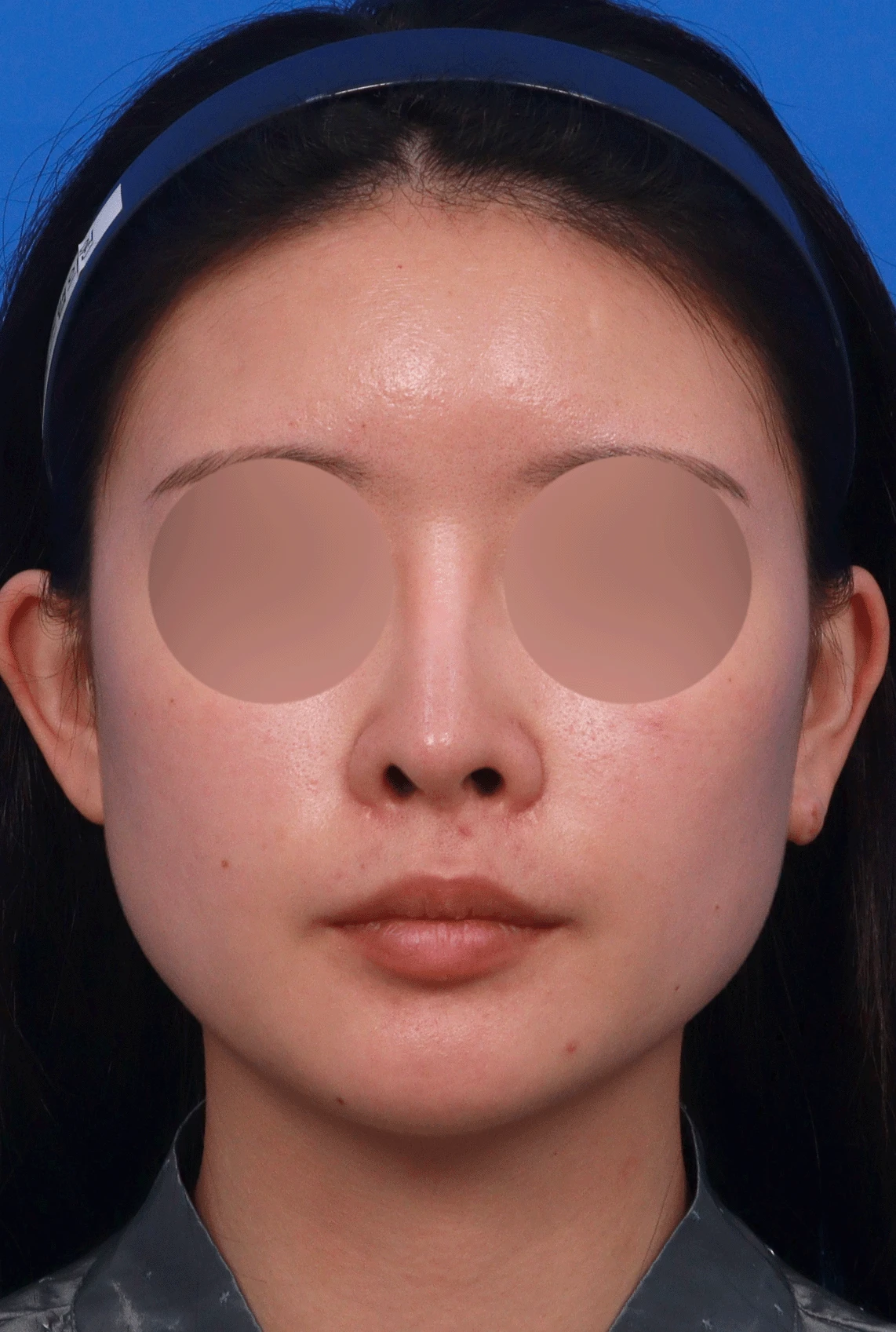 콧대가 인위적으로 보이고 코가 들리는 이유, 재건은 어떻게 하나 — 디자인 상담 정면 , 비스듬한 측면 사진, 좌측 측면