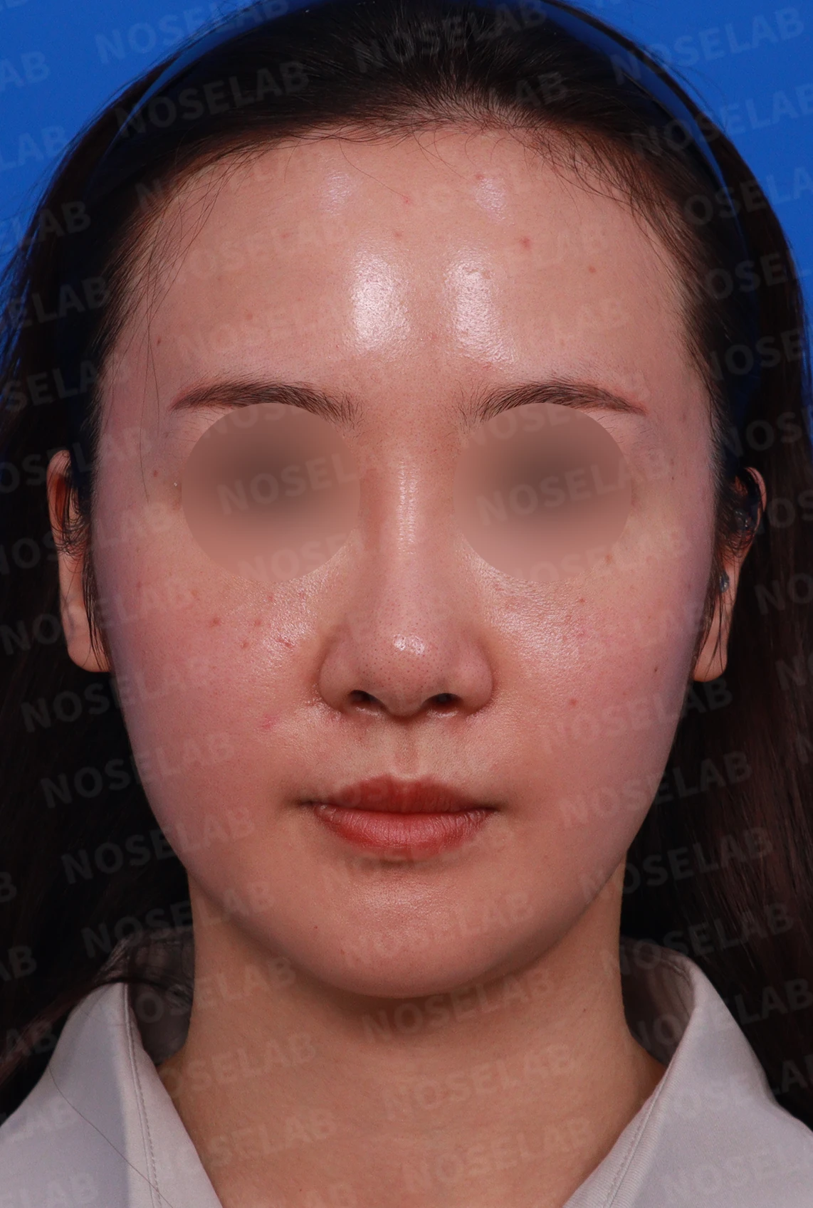 양악수술 뒤 코가 퍼져 보이고 코끝이 처지는 이유, 늑연골 재건 방법 — 디자인 상담 정면 , 비스듬한 측면 , 측면 사진입니다.