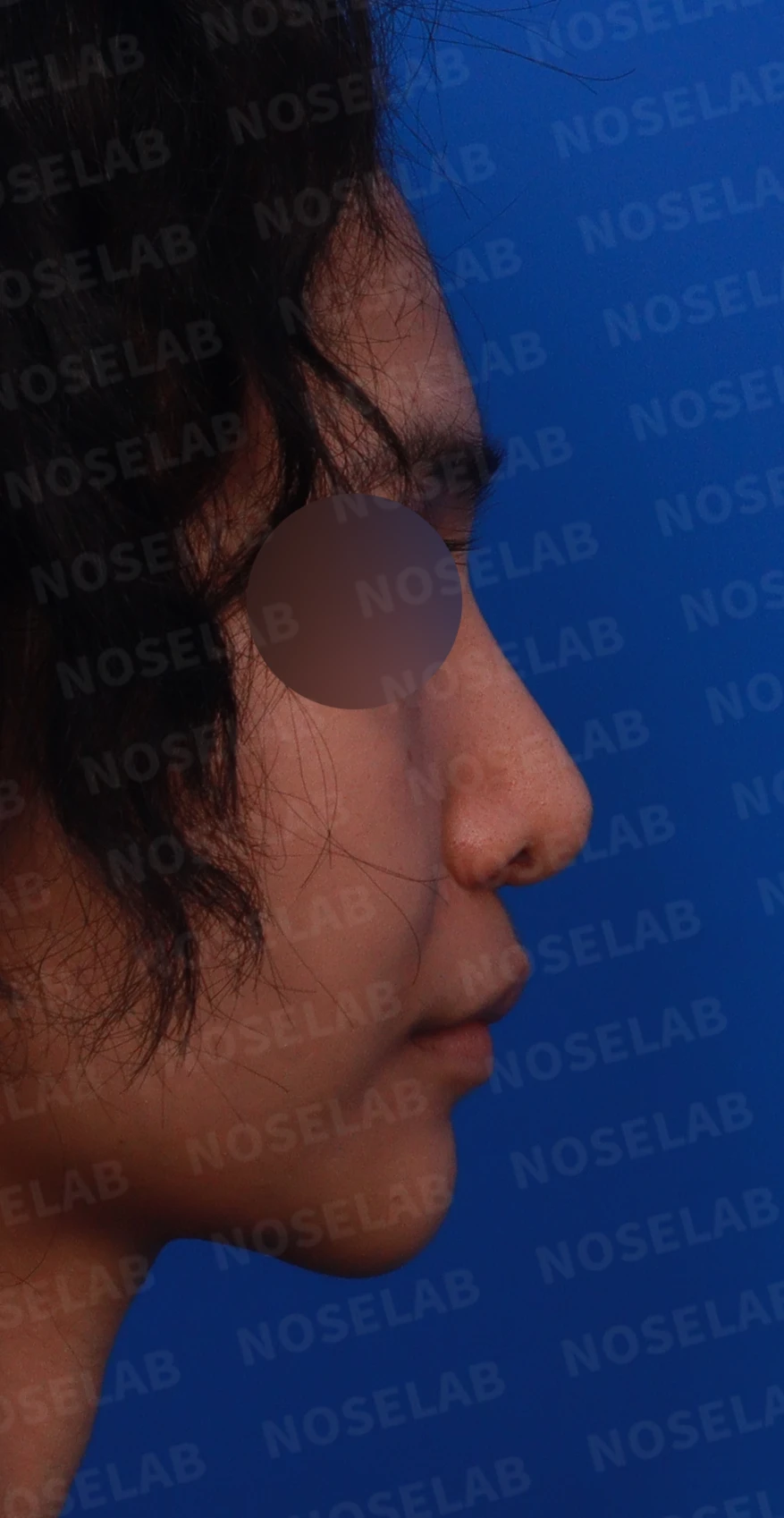 비주가 심하게 처지고 화살코가 되는 이유와 늑연골 재건 방법 — 디자인 상담 우측 측면, 비스듬한 측면, 비공 사진입니다.