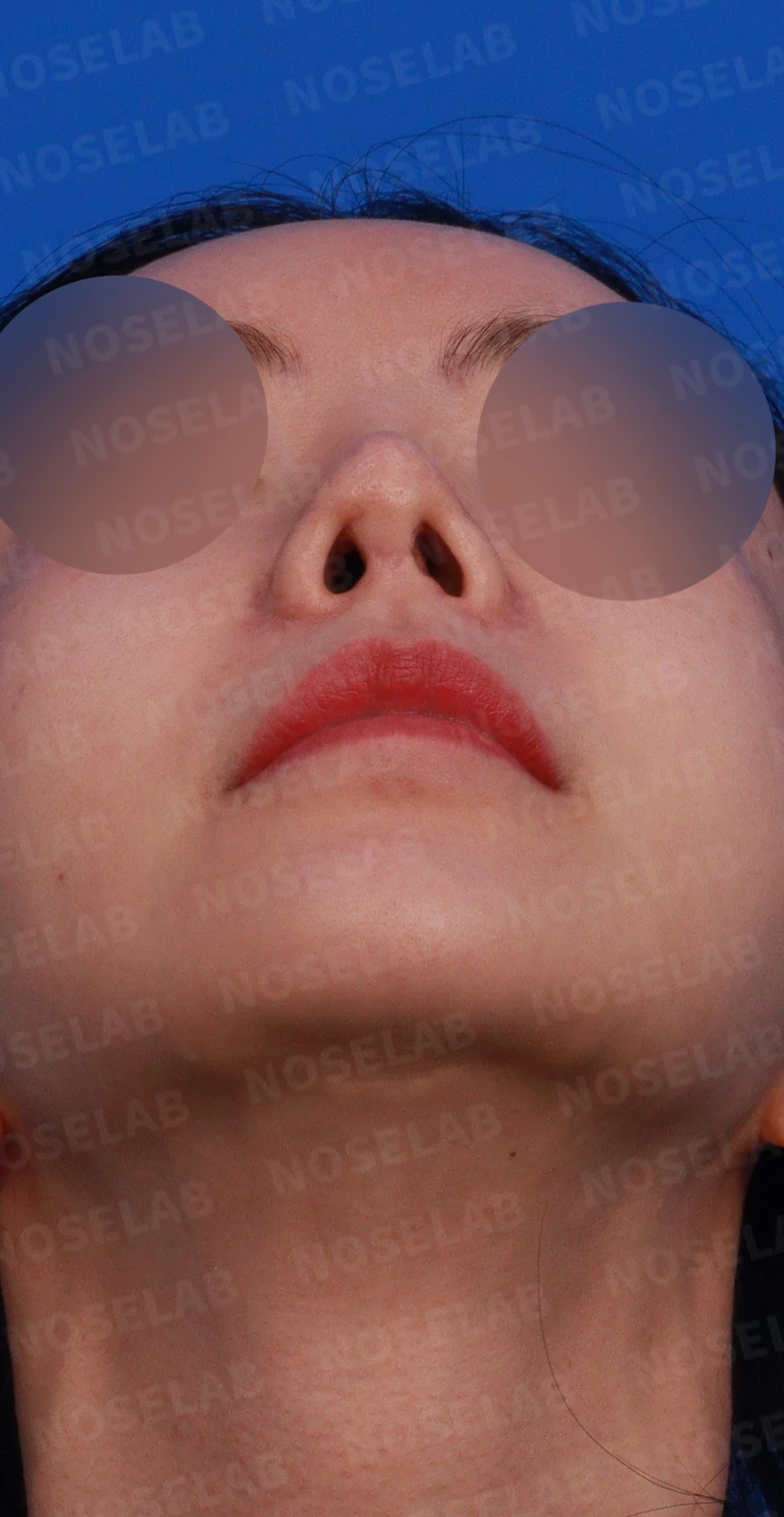 이식한 진피가 반복해서 흡수되는 이유, 재건은 어떻게 하나 — 디자인 상담 우측 비스듬한 측면, 측면, 비공 사진입니다.