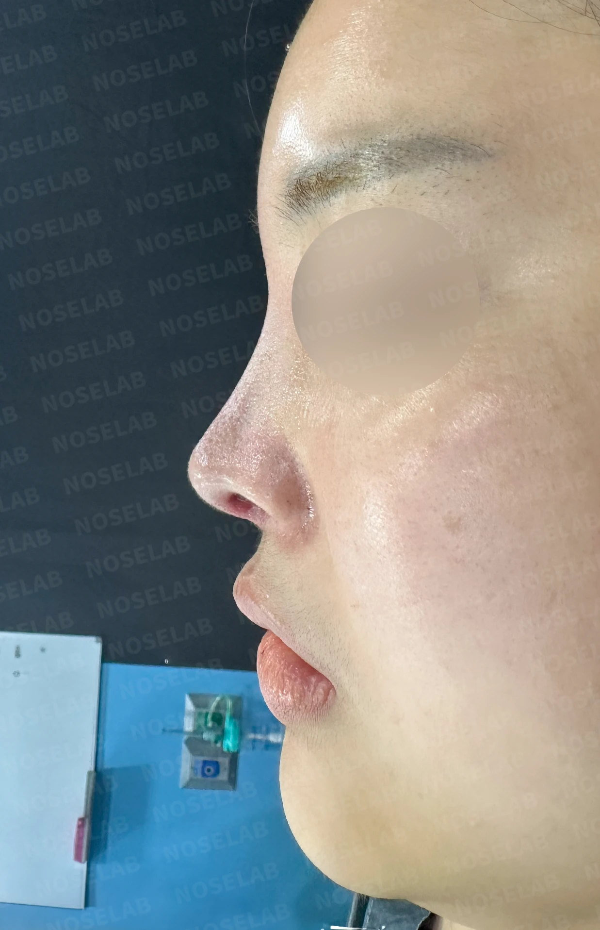 퍼진 콧대와 들린 코끝은 왜 생기나, 늑연골 재건은 어떻게 하나 — 수술 직후 0일 정면, 측면, 비스듬한 측면 사진 직후 사진은 부기가 있는 상태로 최종 결과와 다를 수 있습니다.