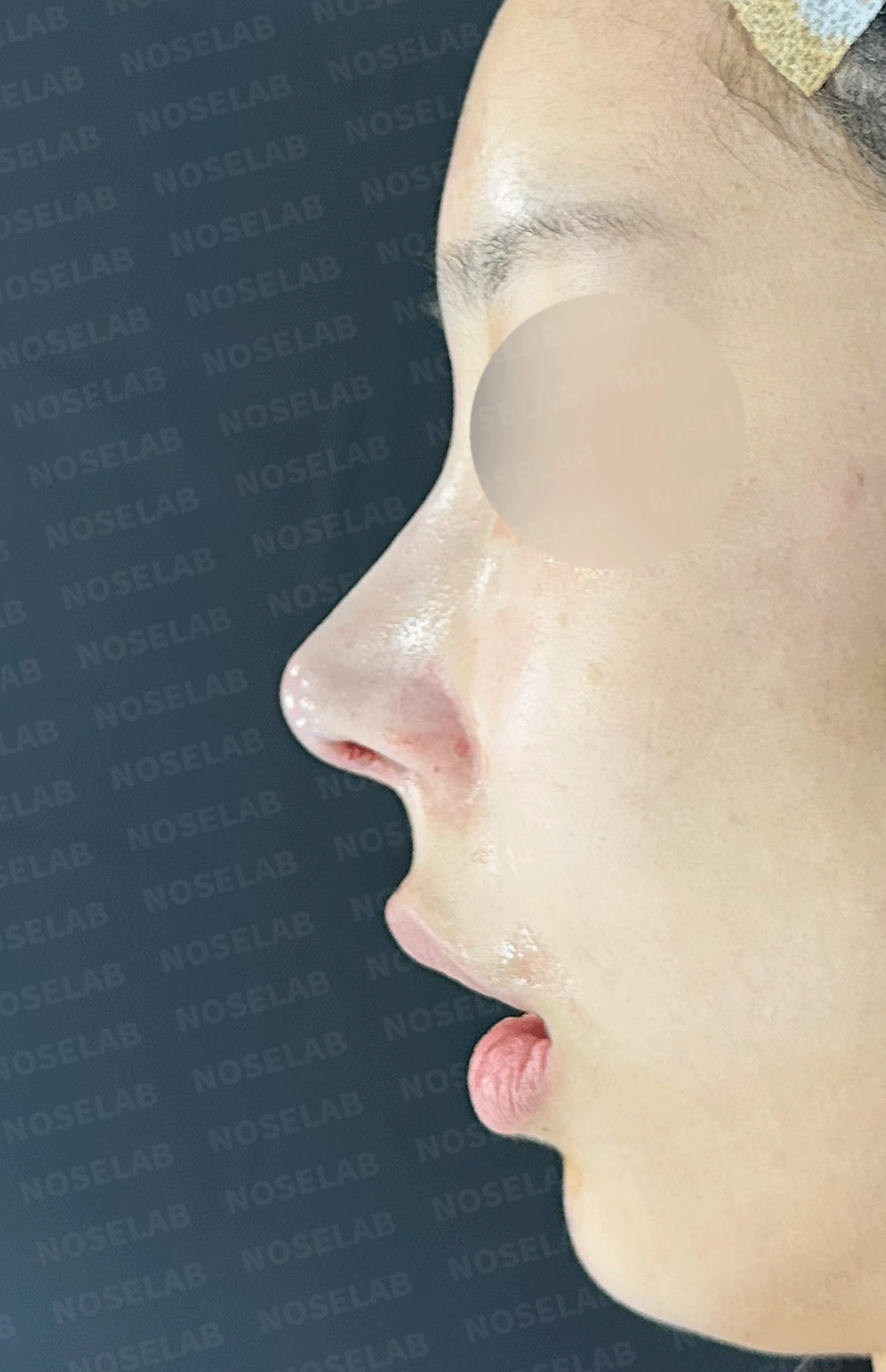 여러 번 수술한 코에 연골이 비치는 이유와 점막·구조 복원 방법 — 수술 직후 0일 정면 , 측면 , 비스듬한 측면 사진입니다. 직후 사진은 부기가 있는 상태로 최종 결과와 다를 수 있습니다.