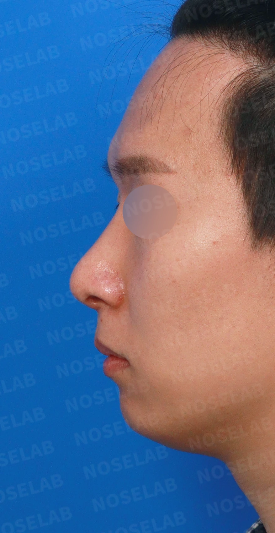한쪽 비골이 함몰되면 왜 코가 휘어 보이는가, 절골 복원과 비중격 재건 — 디자인 상담 정면, 좌측 측면, 비스듬한 측면 사진