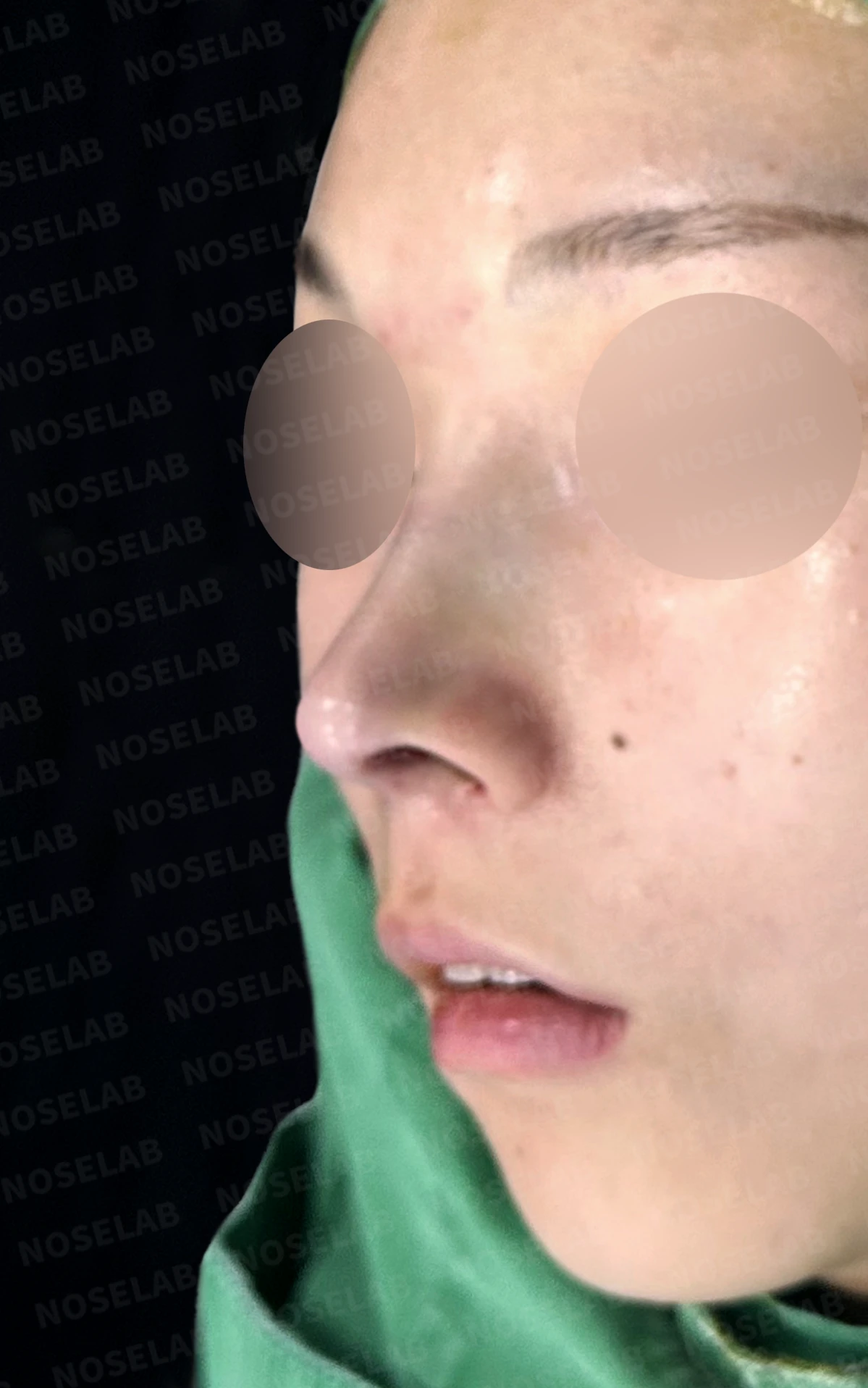 낮고 퍼진 코, 기증늑연골과 실리콘 보형물로 자연스러운 코 라인 완성 — 전(좌) 직후(후)
