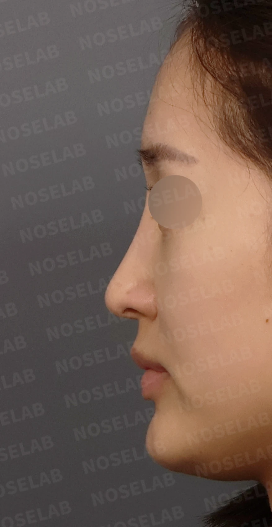 코성형 뒤 코끝이 처져 코가 길어 보이는 이유, 자가늑연골 코끝 재건 방법 — 디자인 상담 정면, 좌측 측면, 비스듬한 측면 사진입니다.