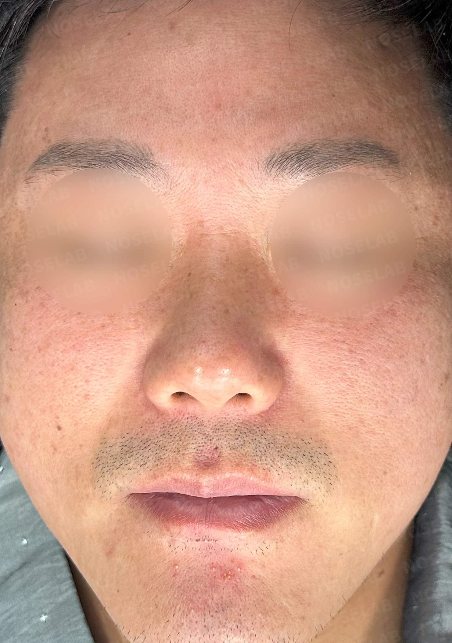 짧고 들린 코의 구조와 교정 방법 — 수술 전 / 수술 직후 0일 직후 사진은 부기가 있는 상태로 최종 결과와 다를 수 있습니다.